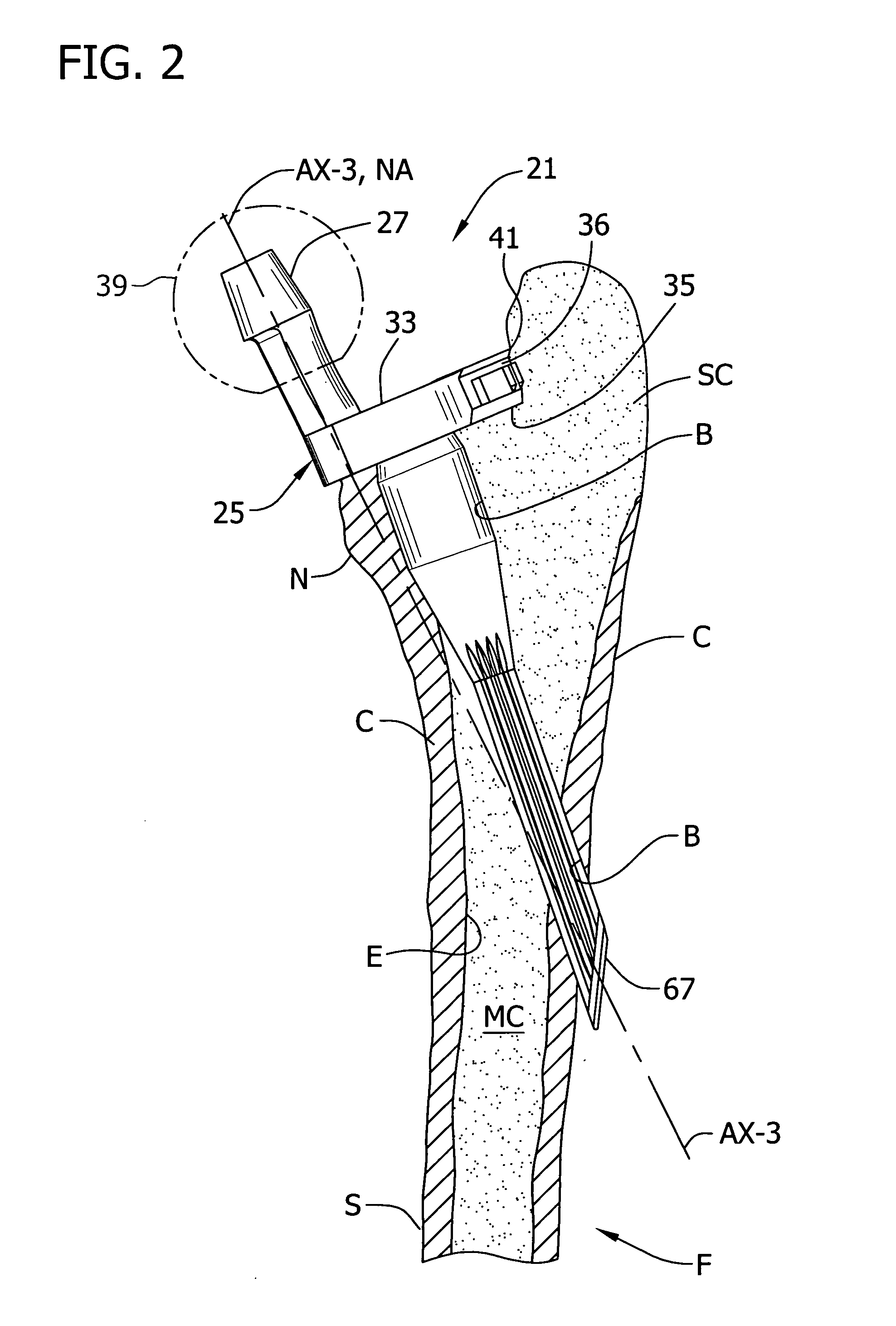 Prosthesis and method of implantation