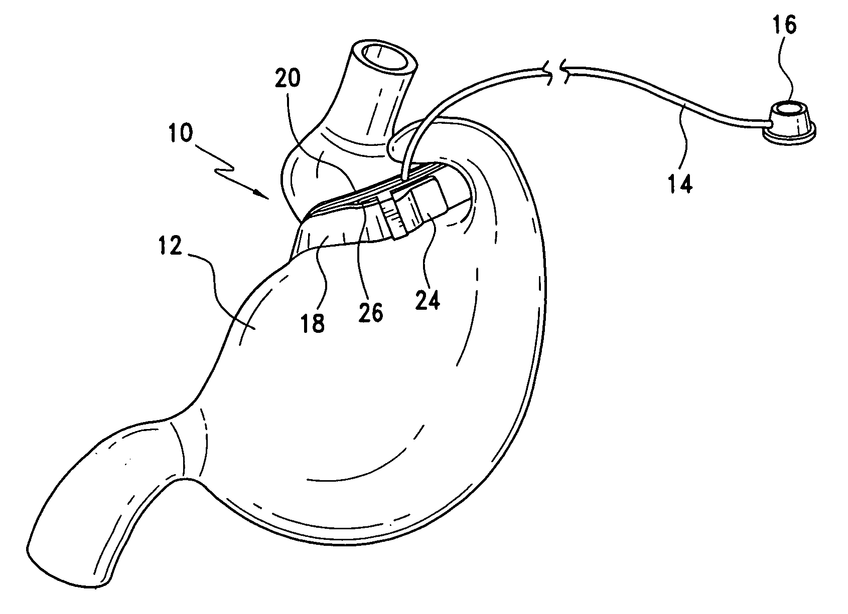 Accordion-like gastric band