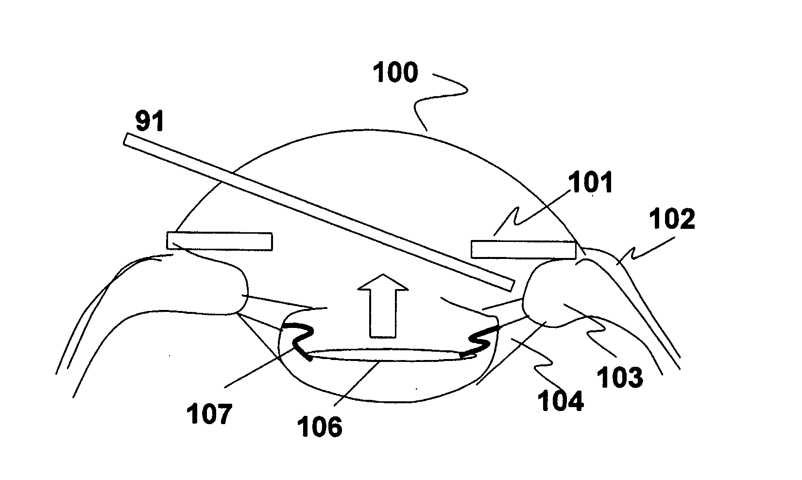 Method and system for endoscope-assisted non-invasive laser treatment of presbyopia