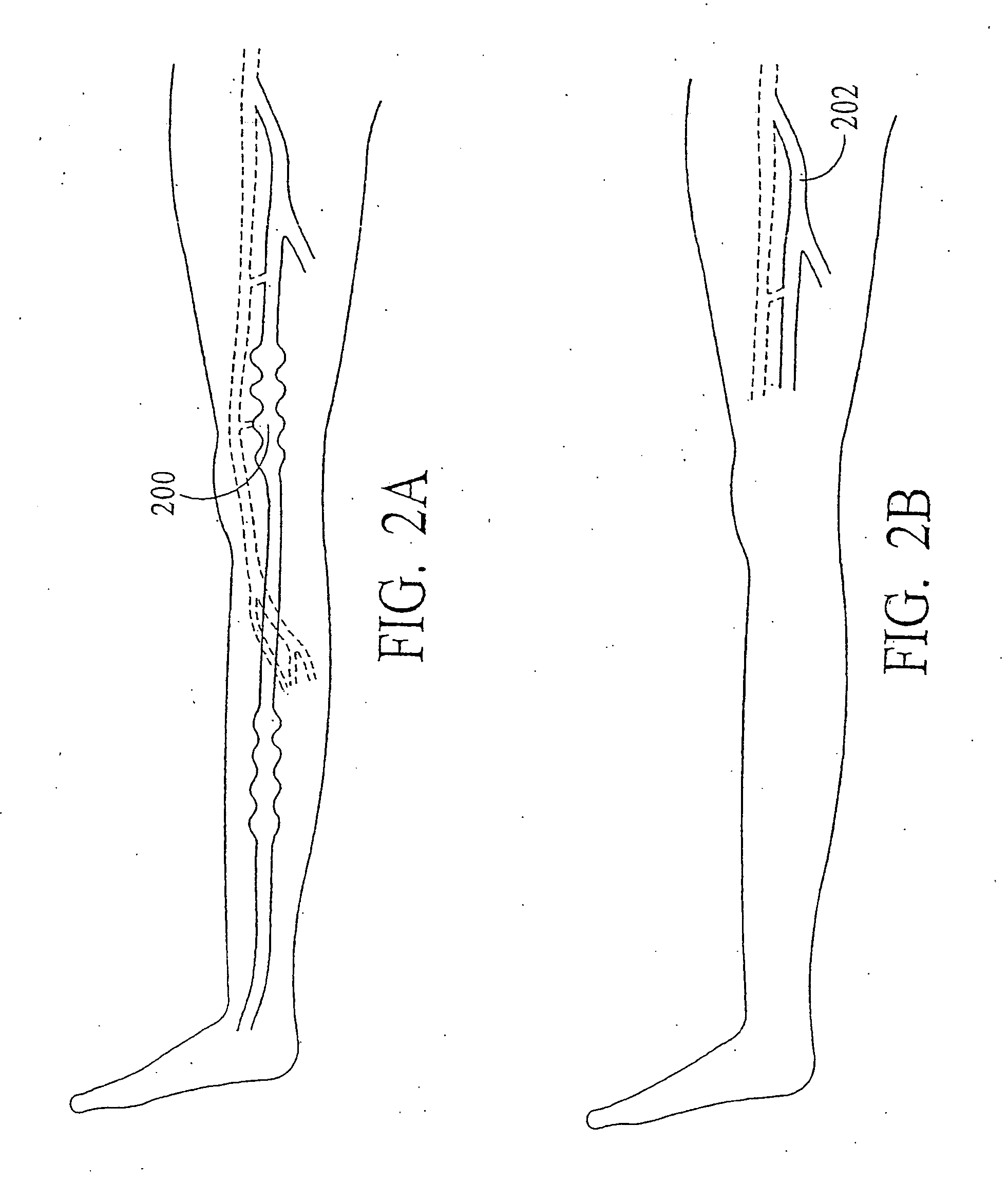 Endovenous closure of varicose veins with mid infrared laser