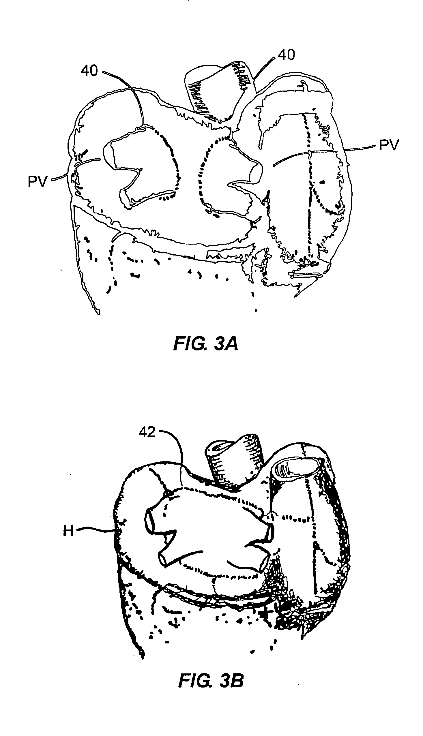 Method for non-invasive lung treatment