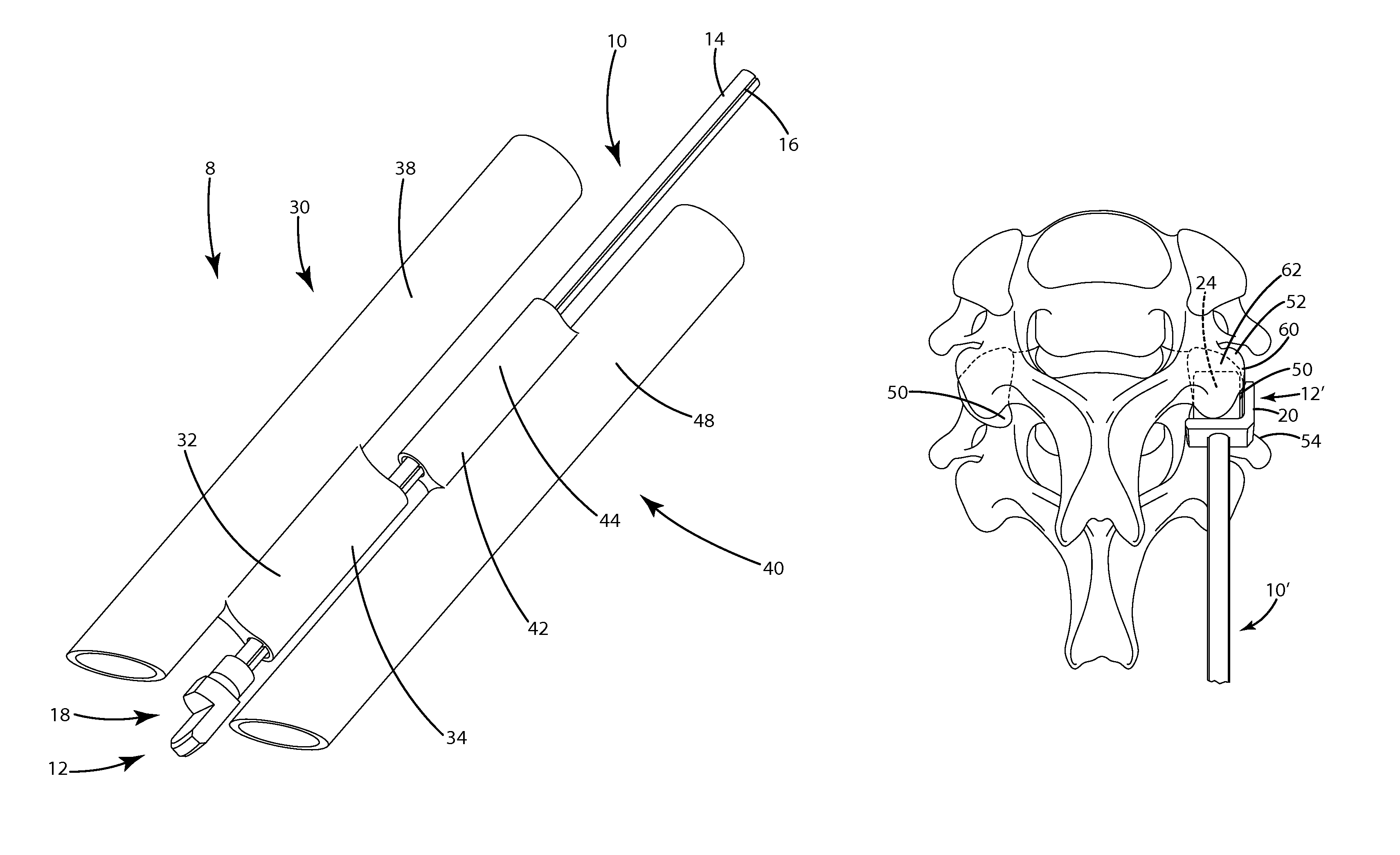 Posterior cervical fusion system and techniques