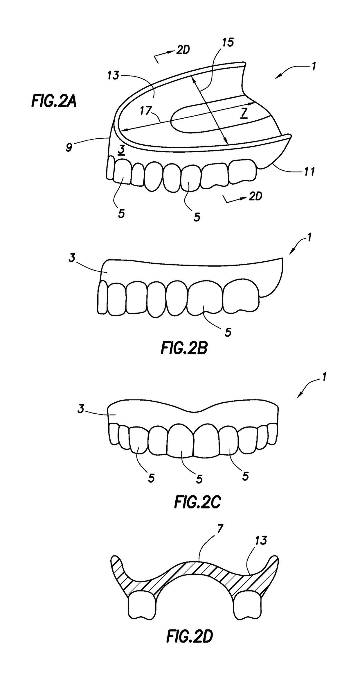 One visit denture