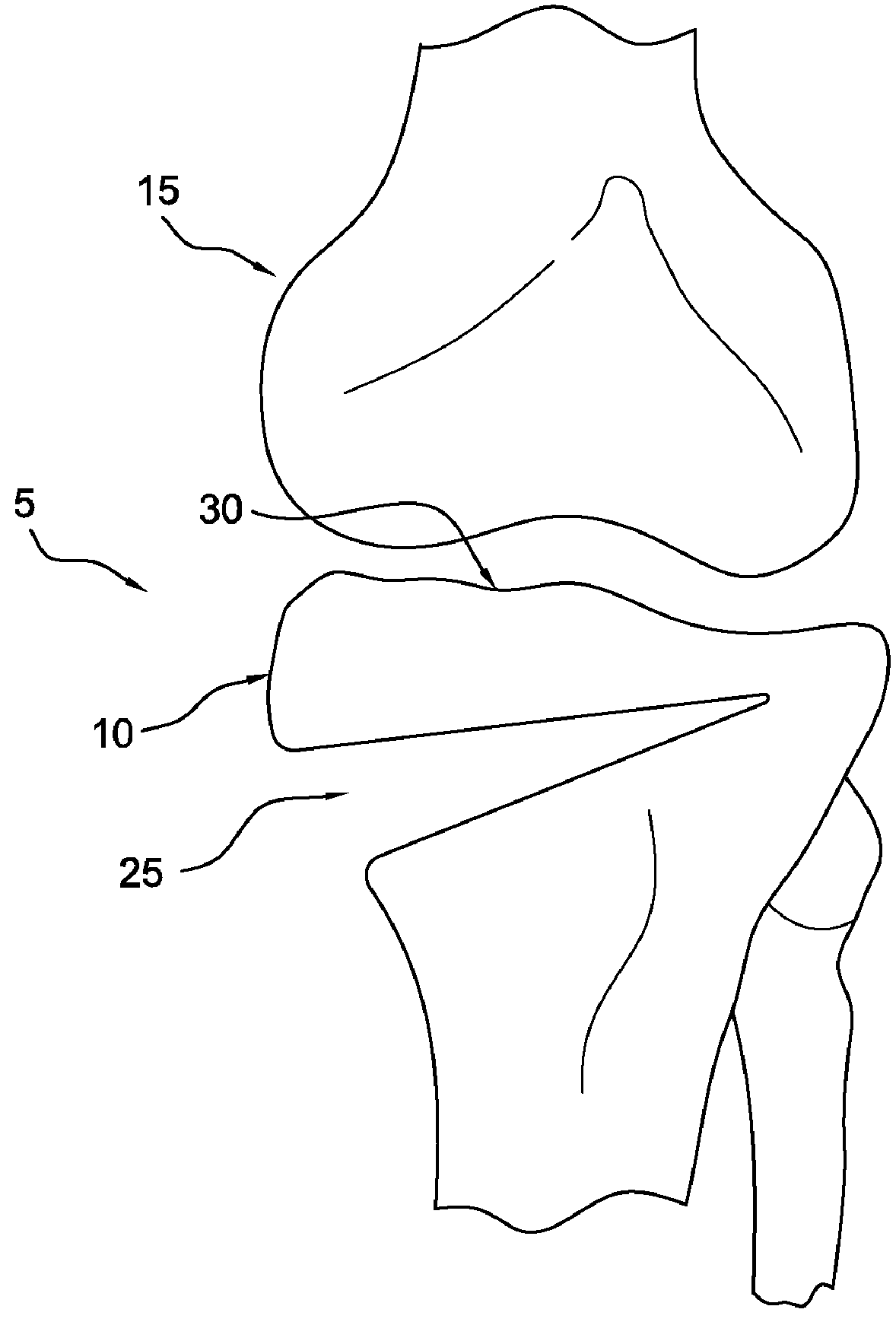 Method and apparatus for reconstructing a ligament and/or repairing cartilage, and for performing an open wedge, high tibial osteotomy