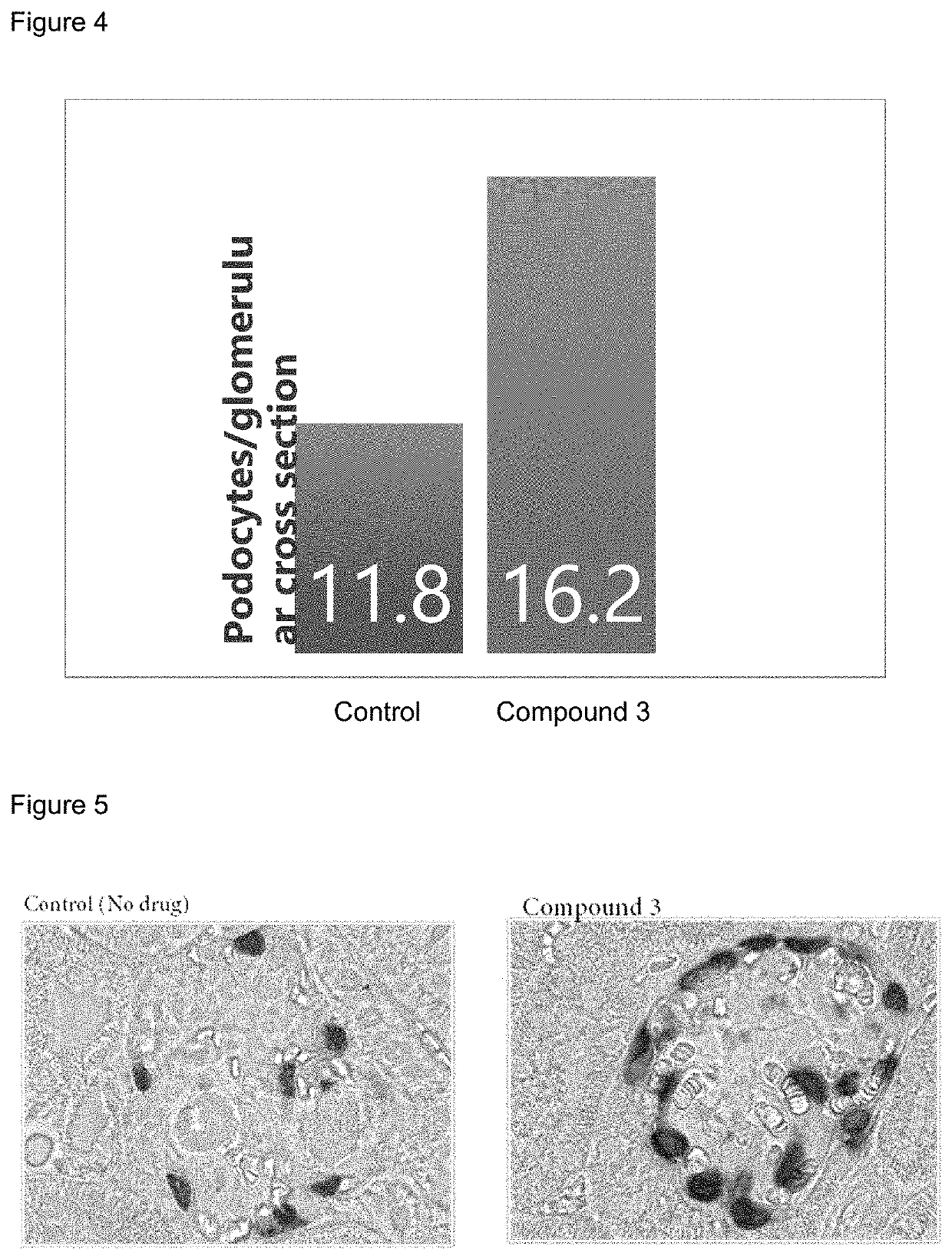 Method of Treating Focal Segmental Glomerulosclerosis