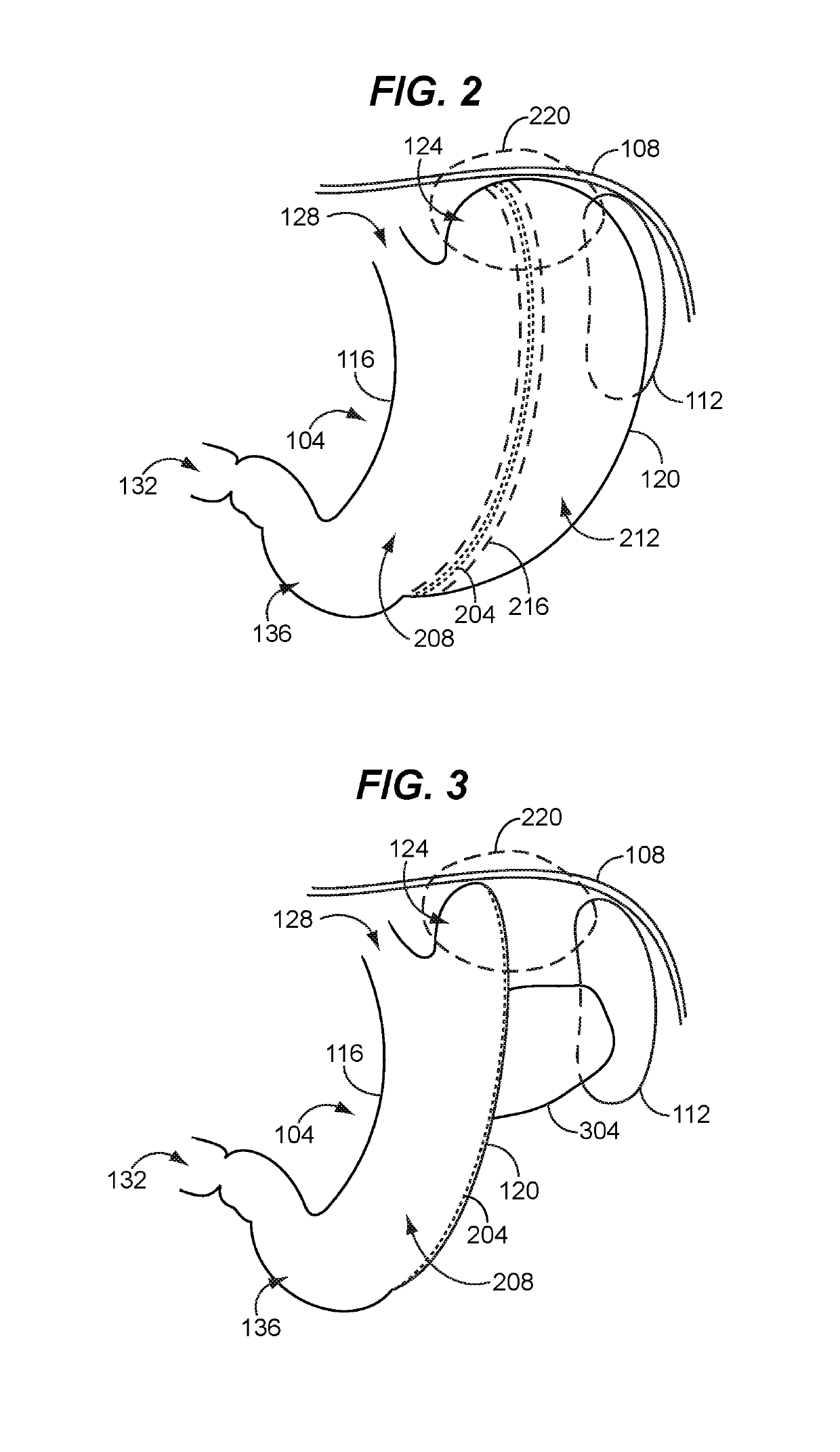 Safe sleeve gastrectomy and intestinal switch