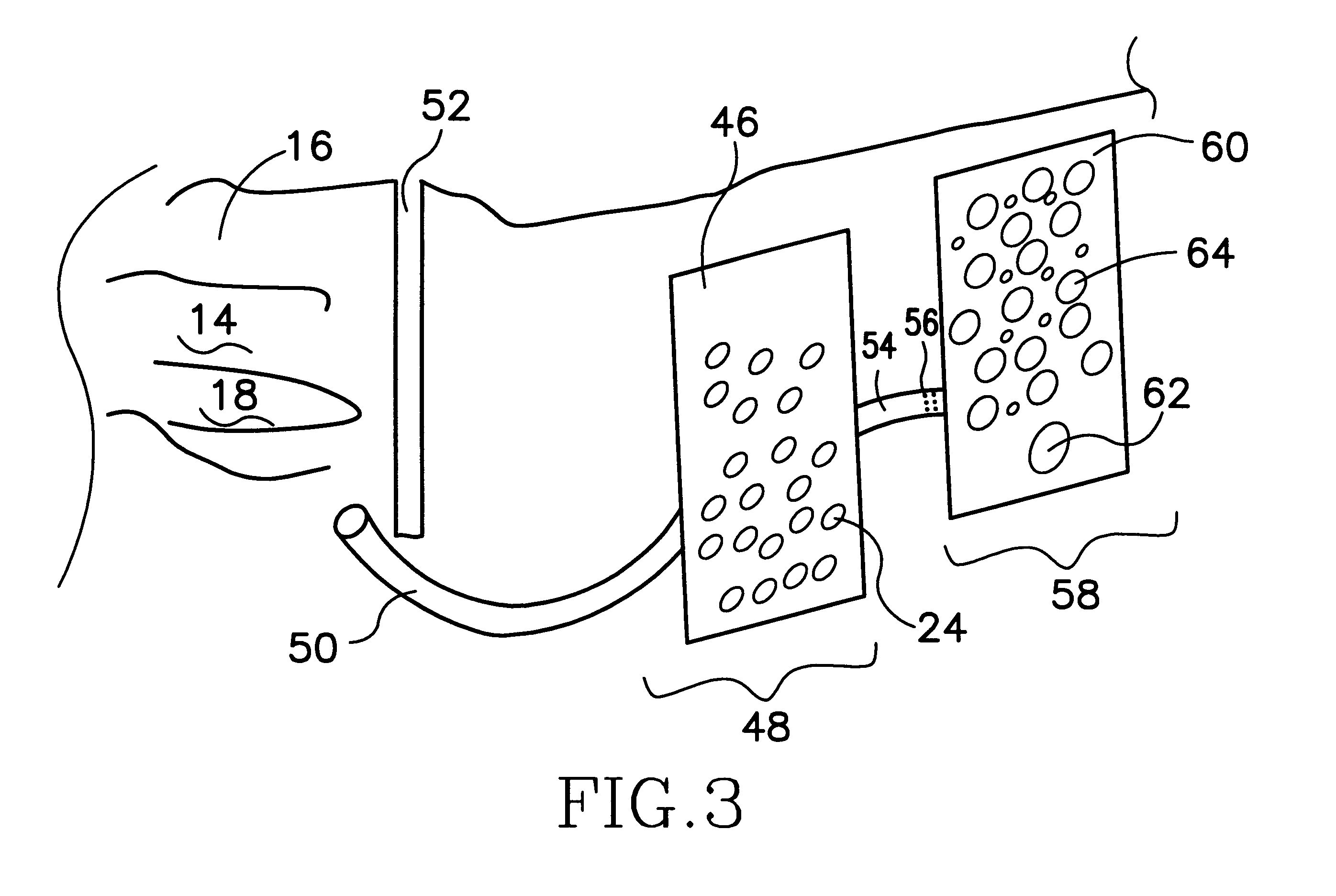 In-situ method to remove iron and other metals from solution in groundwater down gradient from permeable reactive barrier