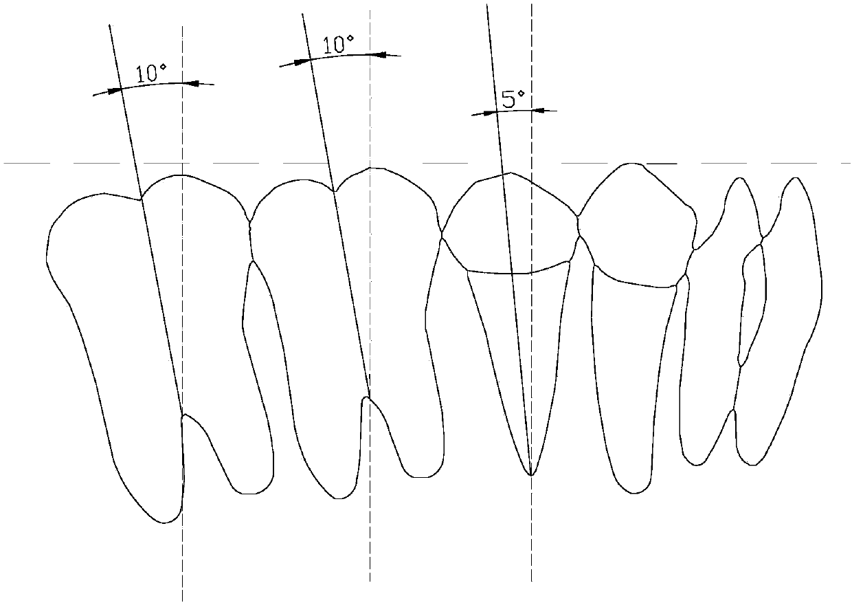 A molar anchorage control method for invisible orthodontic treatment of tooth extraction cases