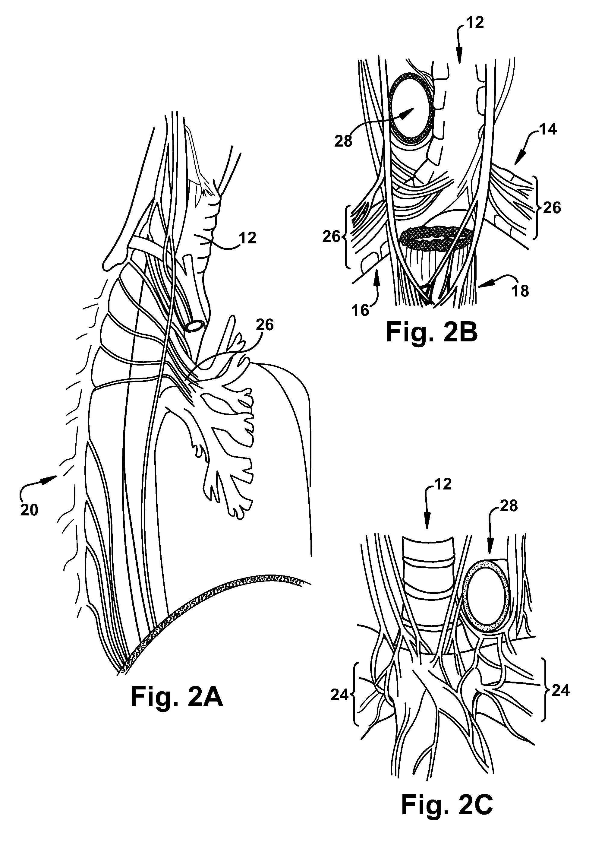 Apparatus and methods for treating pulmonary conditions