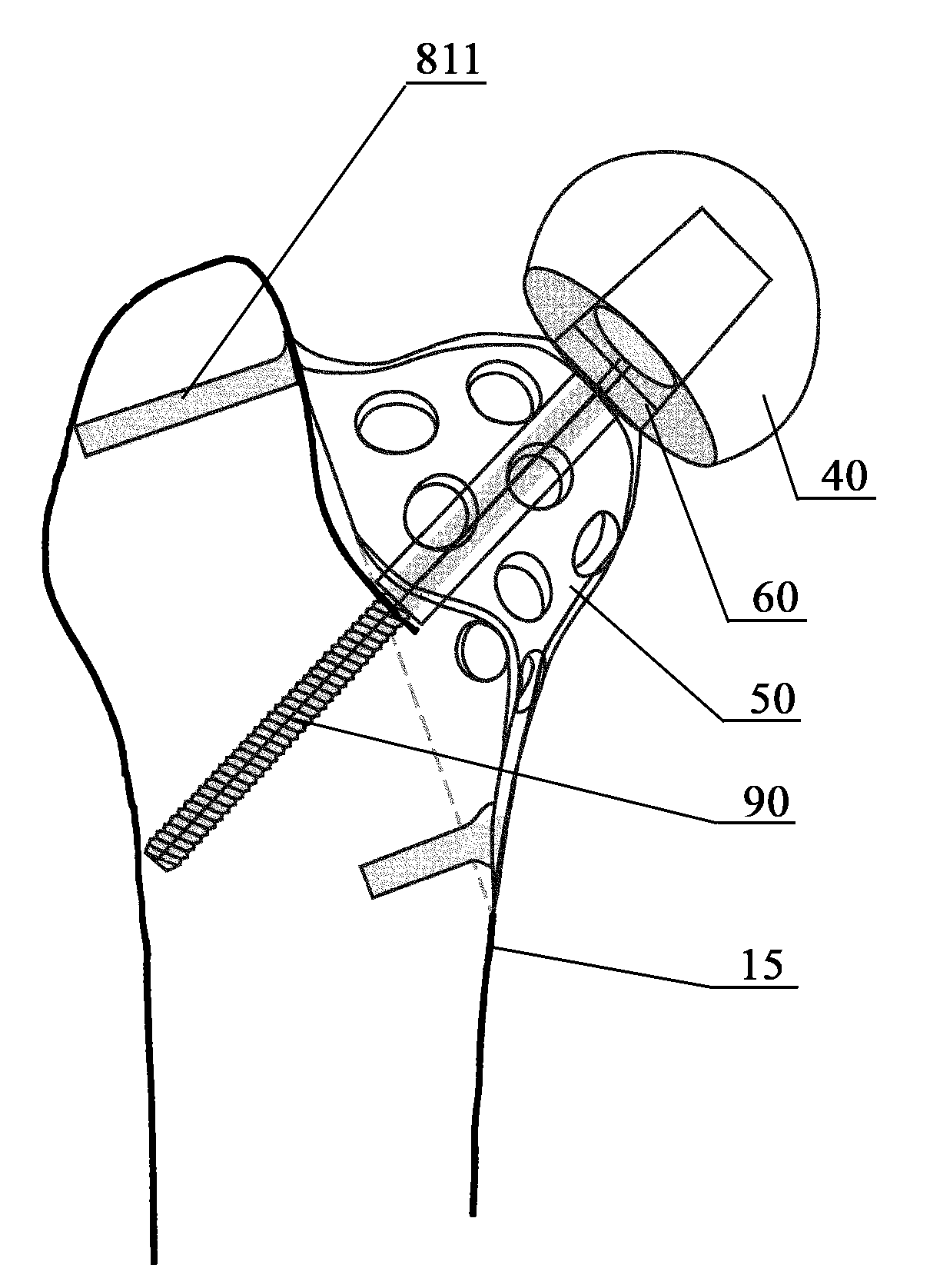 An external proximal femoral prosthesis for total hip arthroplasty