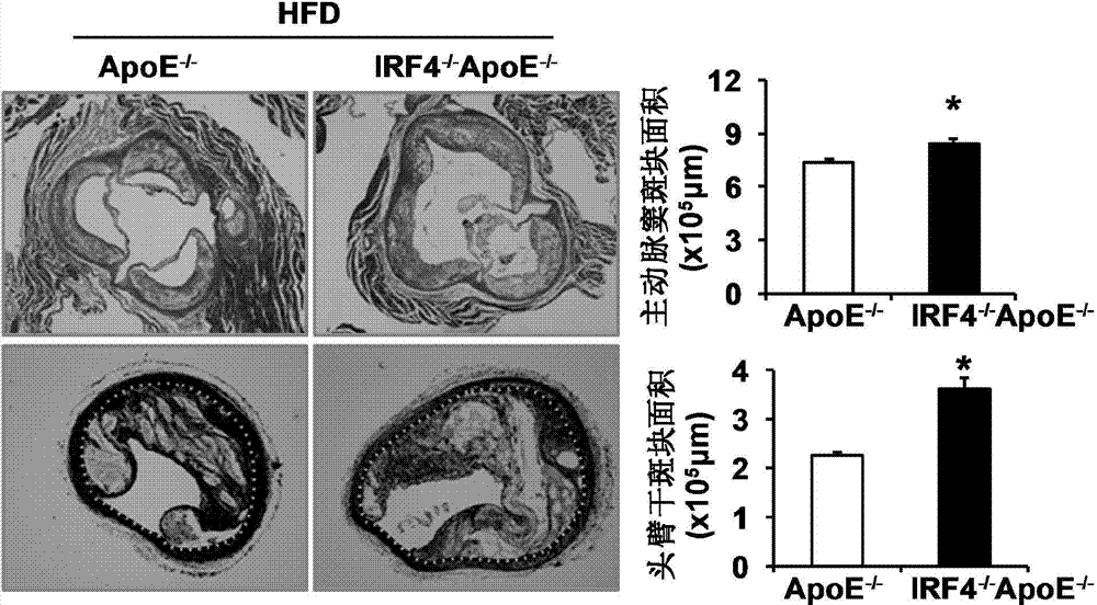 Application of interferon regulatory factor 4 gene in treatment of atherosclerosis