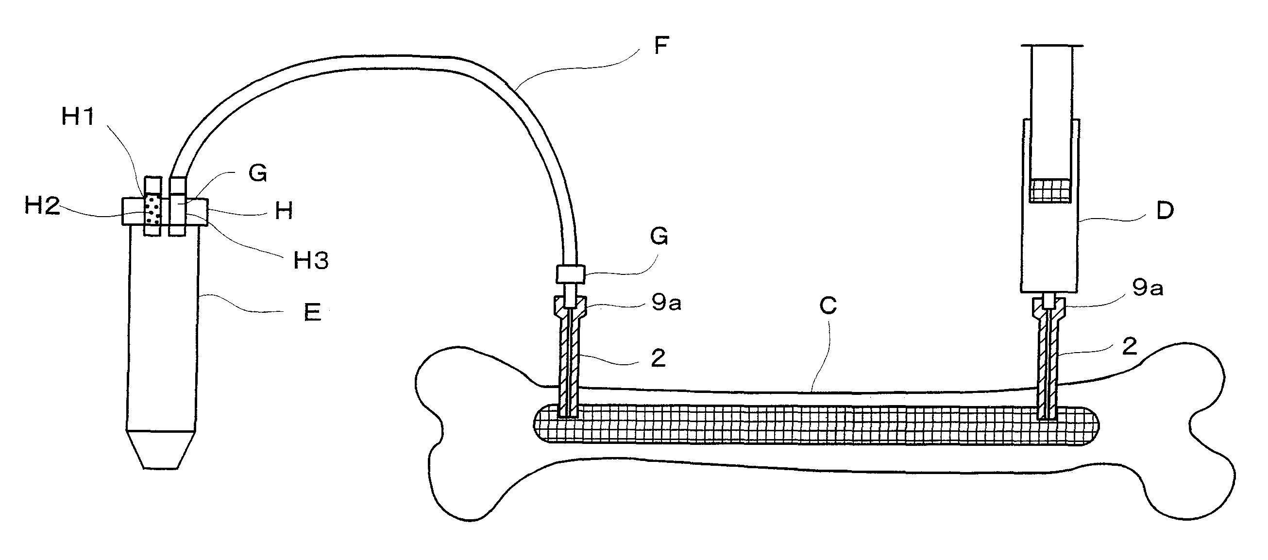 Bone marrow harvesting set and bone marrow harvesting needle