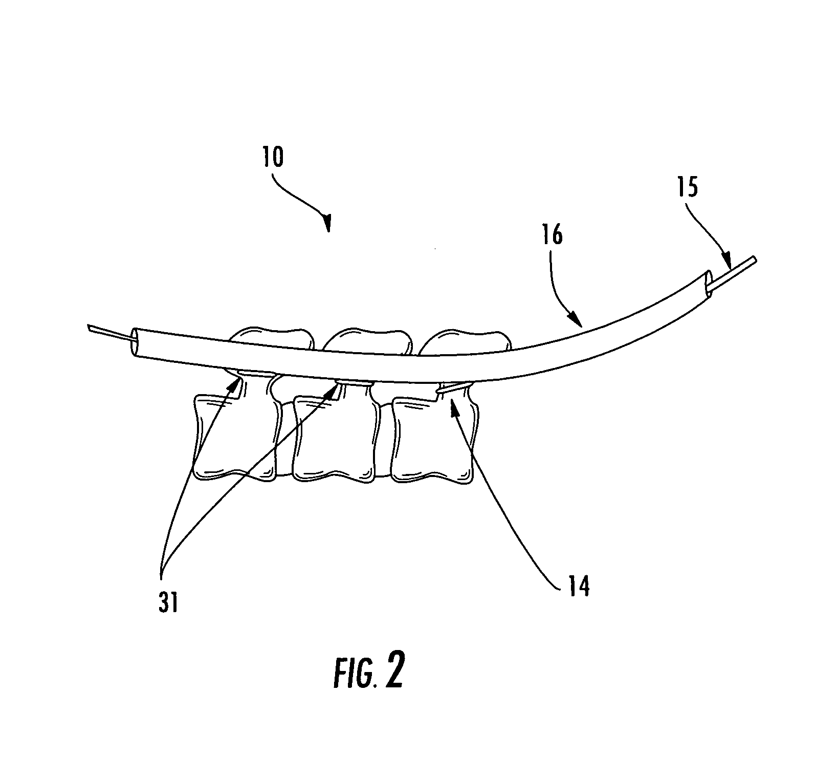 Percutaneous posterolateral spine fusion