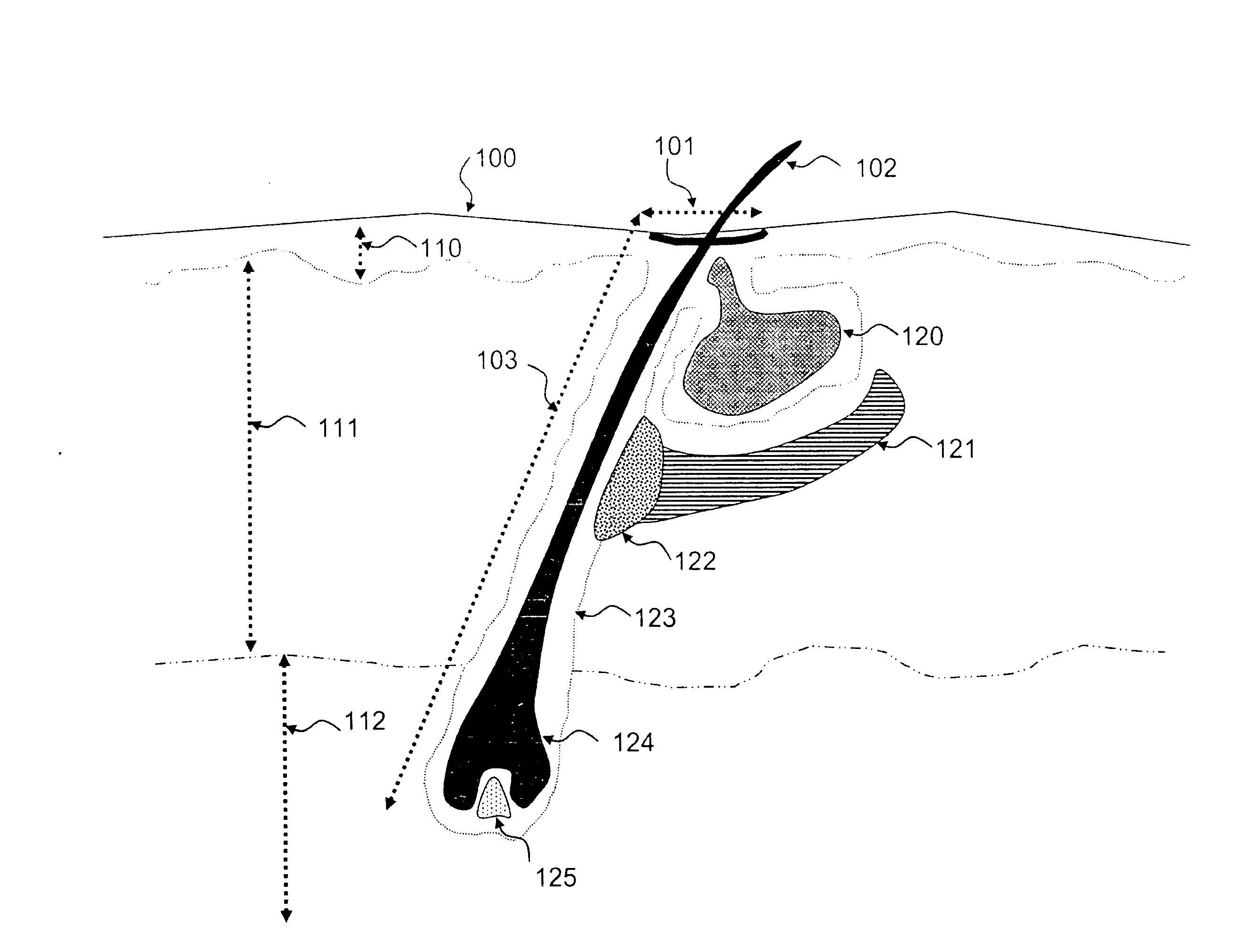 Apparatus and method for hair removal and follicle devitalization