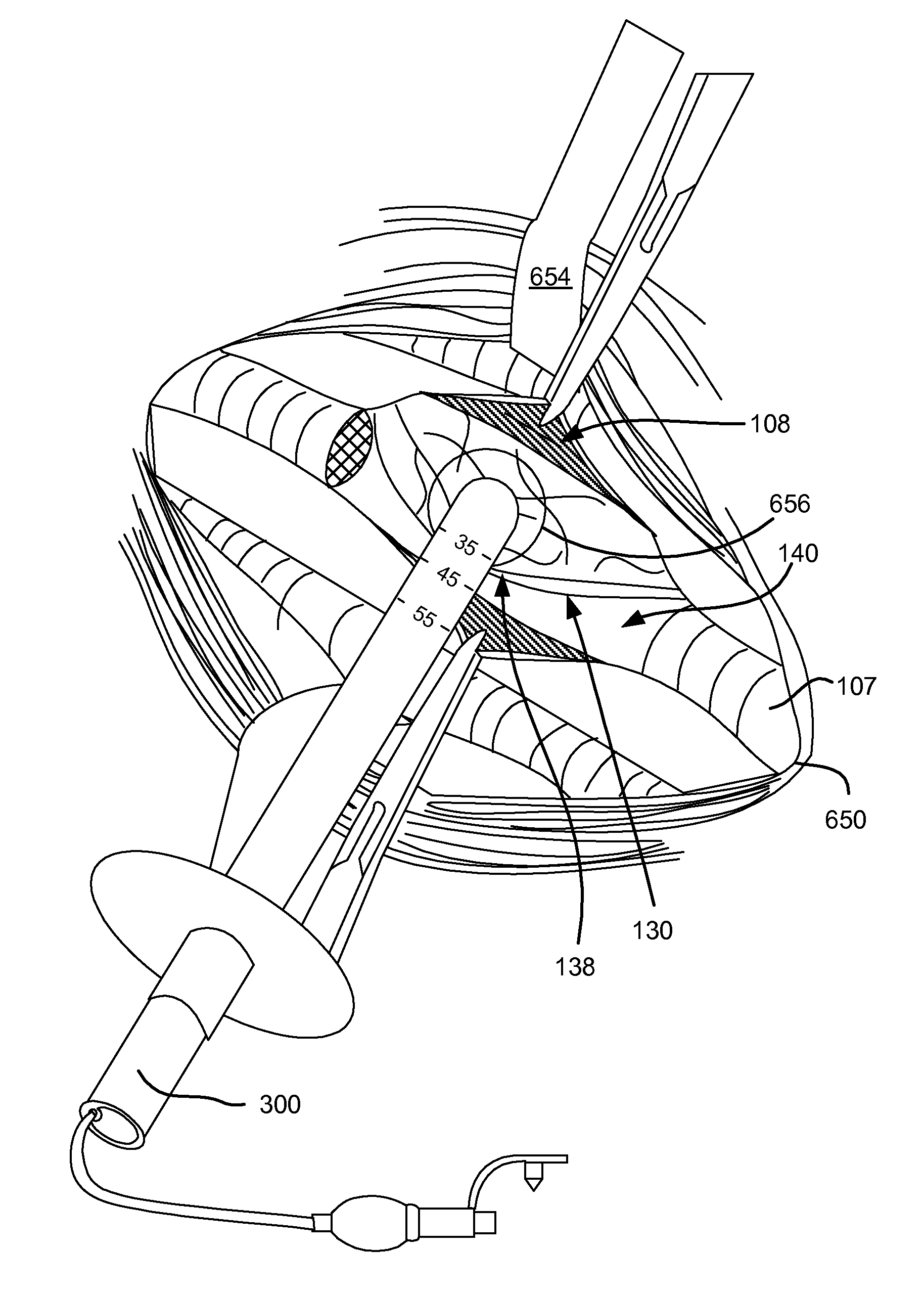 Two-phase surgical procedure for creating a pneumostoma to treat chronic obstructive pulmonary disease