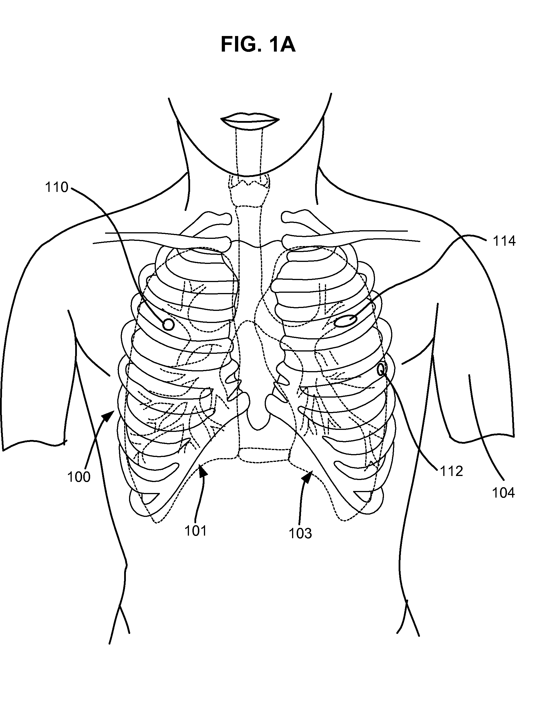 Two-phase surgical procedure for creating a pneumostoma to treat chronic obstructive pulmonary disease