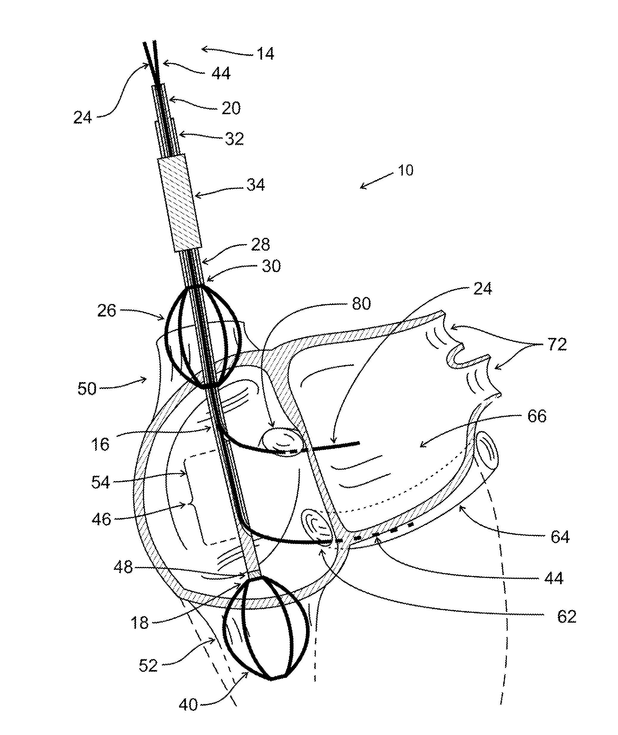 Cardiac Access Catheter, System, and Method