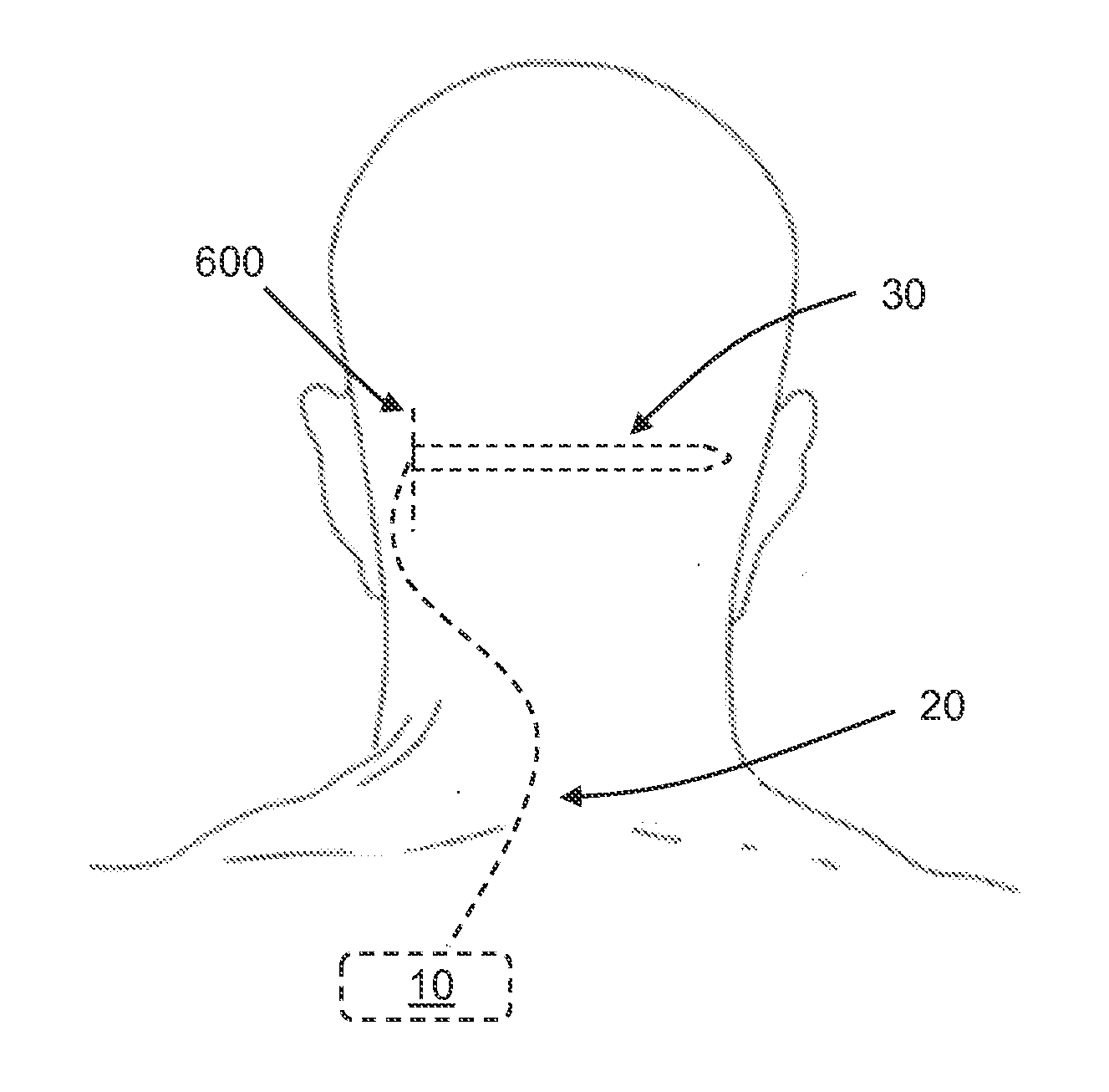 Self-Tunneling Lead