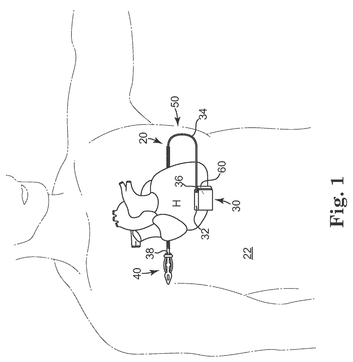 Subcutaneously implantable lead including distal fixation mechanism