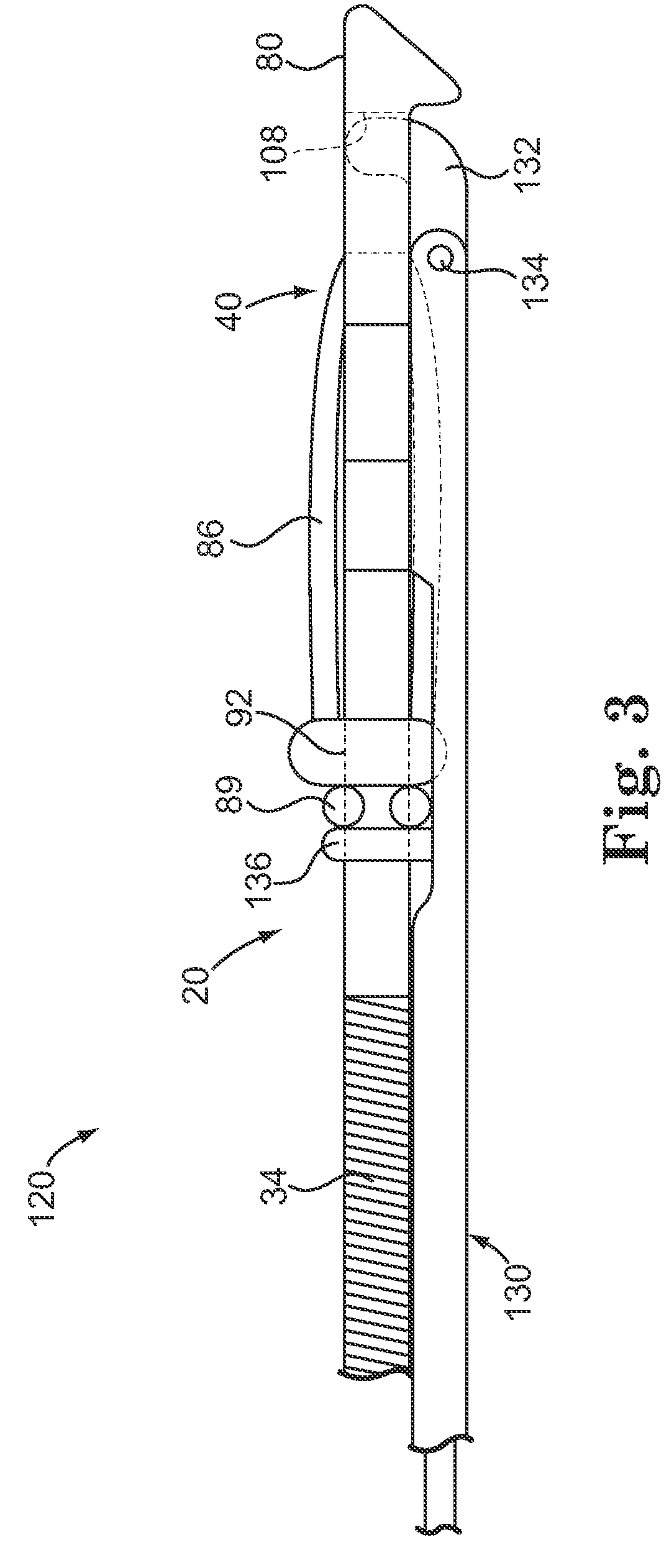 Subcutaneously implantable lead including distal fixation mechanism