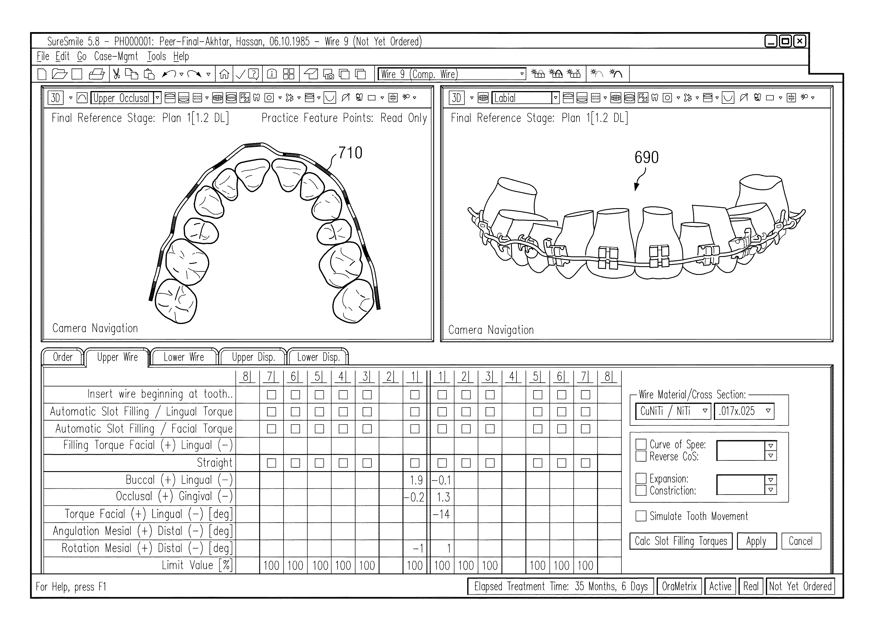 Compensation orthodontic archwire design