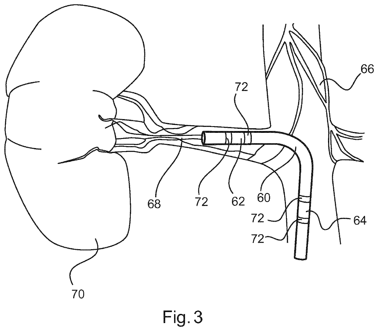 Renal denervation preparation