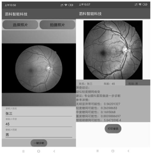 Mobile phone terminal diabetic retinopathy screening APP based on deep learning