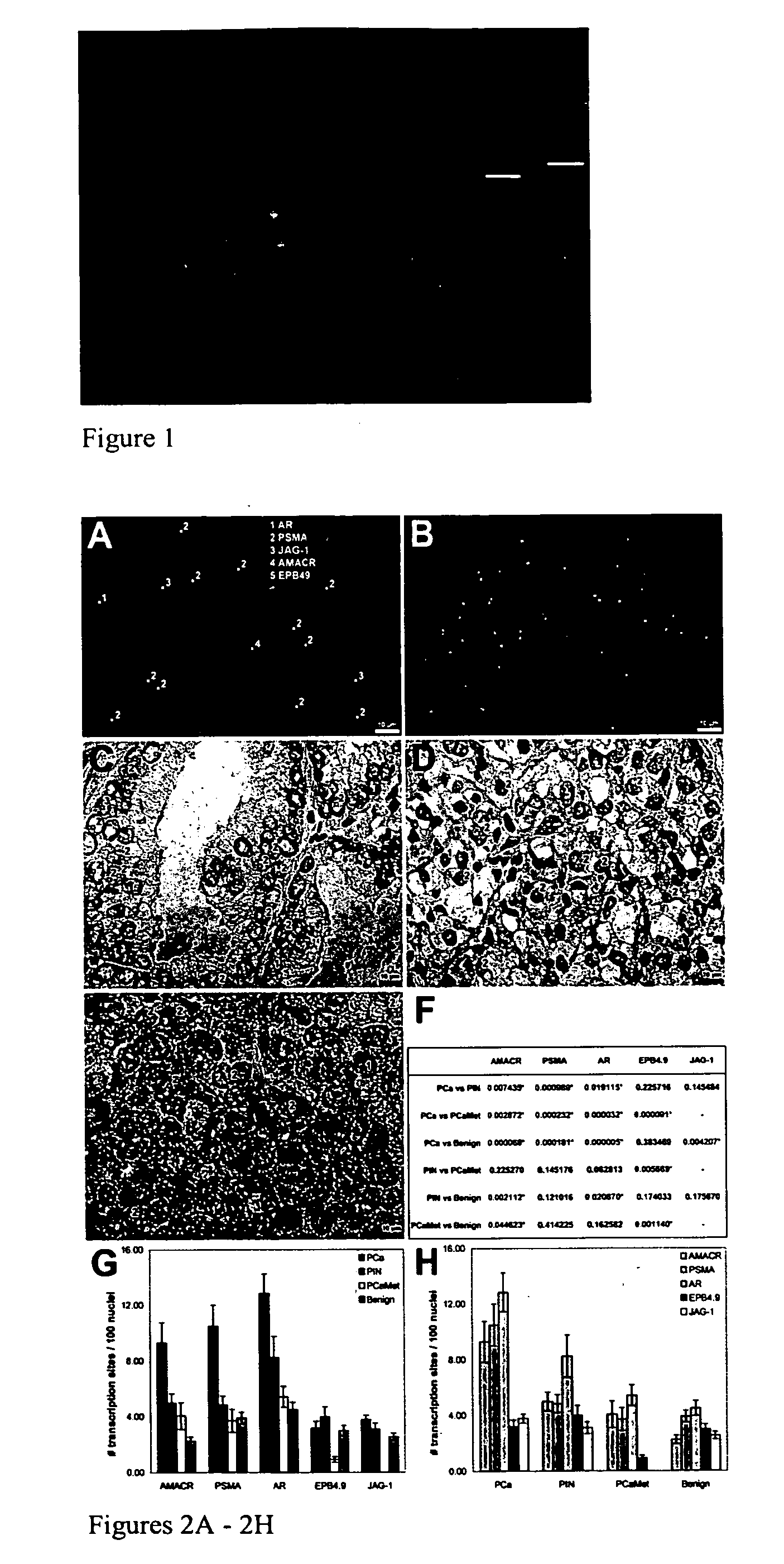 Diagnostic histopathology using multiplex gene expression FISH