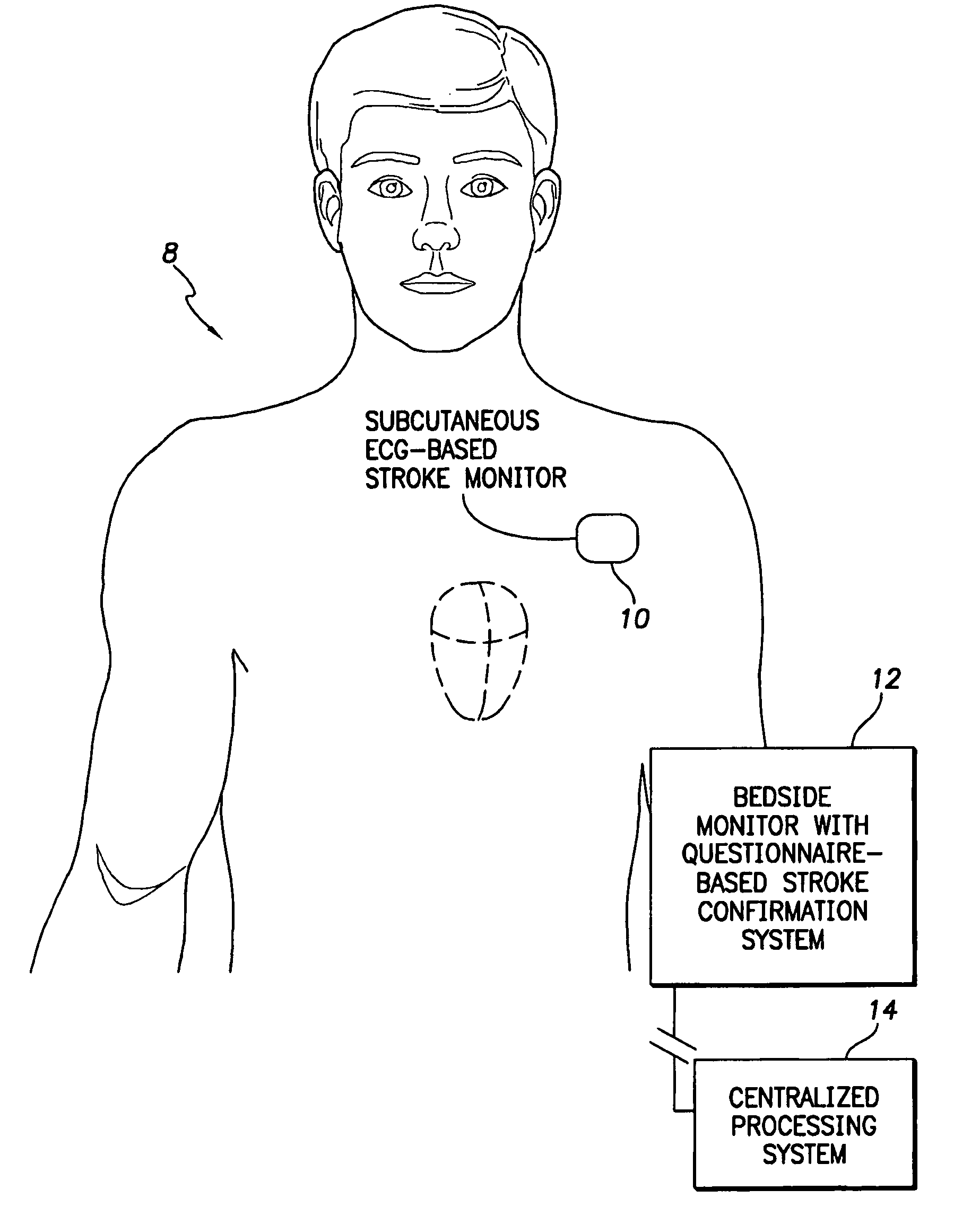 Systems and methods for use with an implantable medical device for detecting stroke based on electrocardiac signals