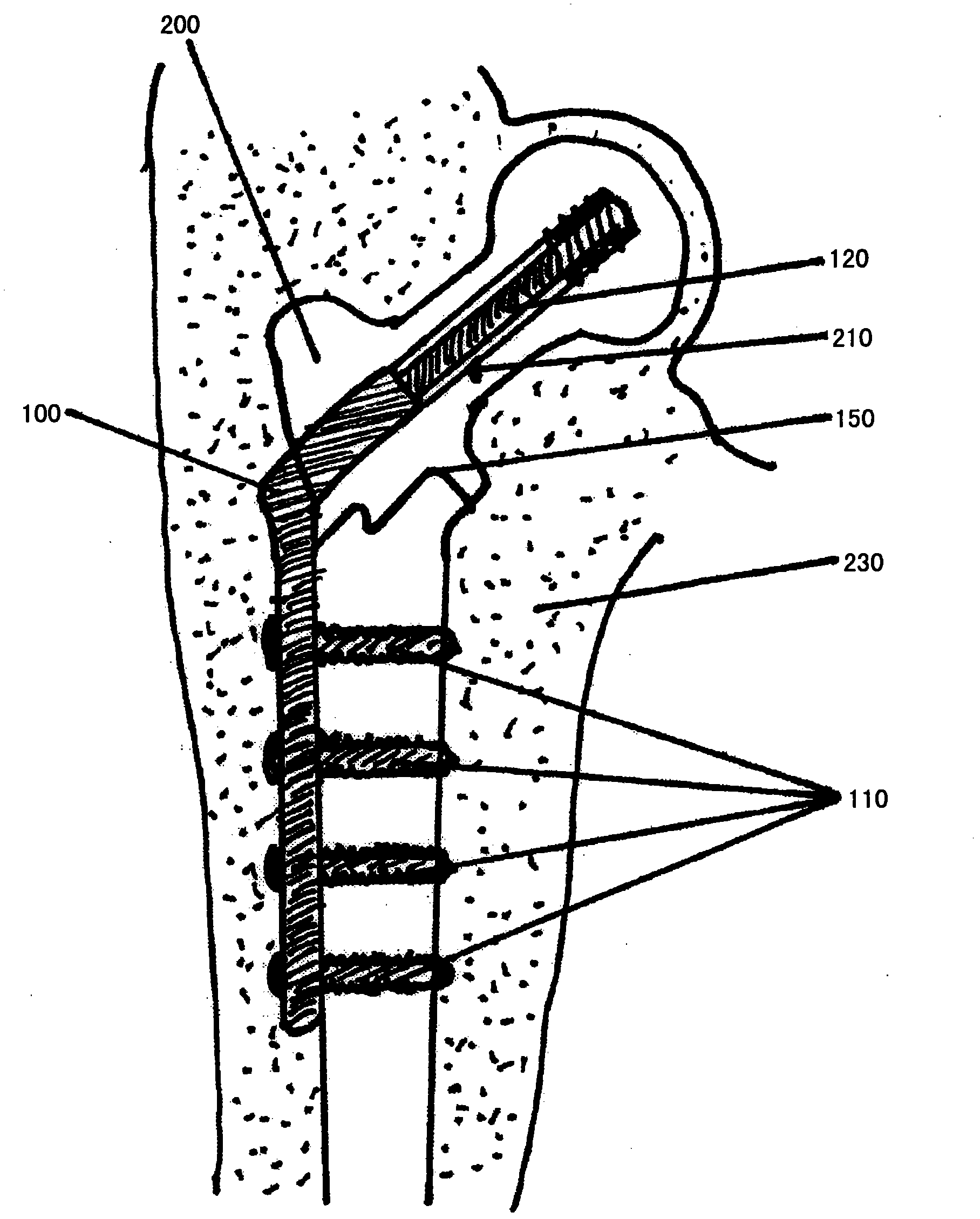 Material for surgical use in traumatology