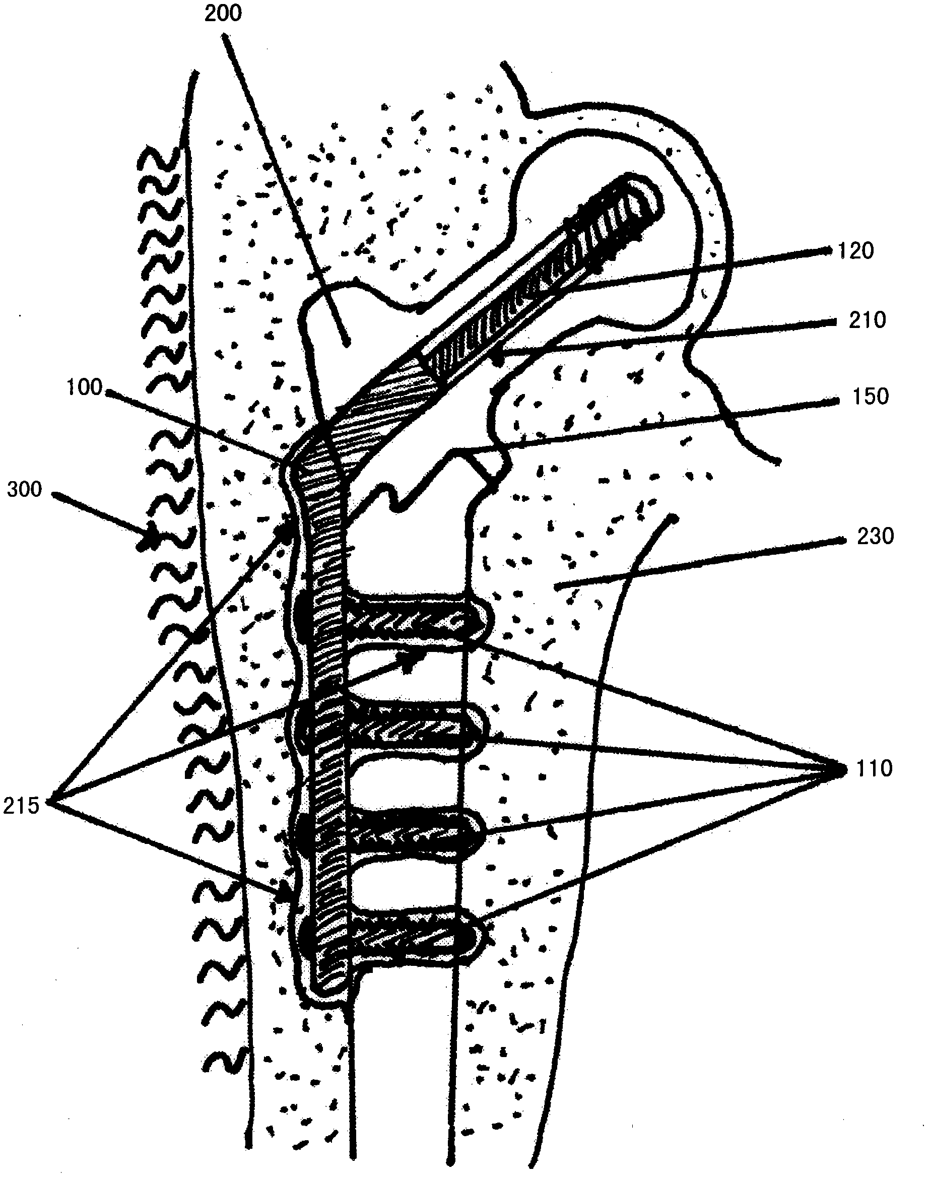 Material for surgical use in traumatology