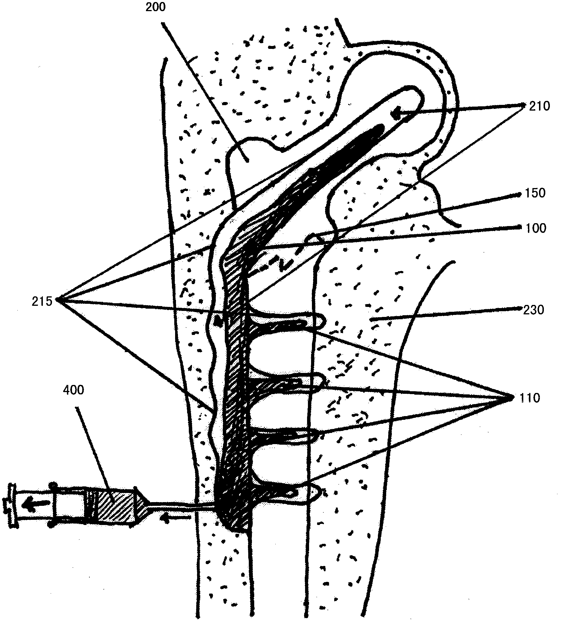 Material for surgical use in traumatology