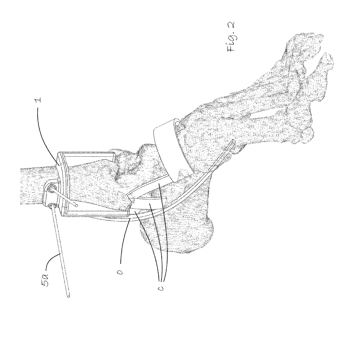 Surgical kit for repair of articular surfaces in the talocrural joint including surgical saw guide