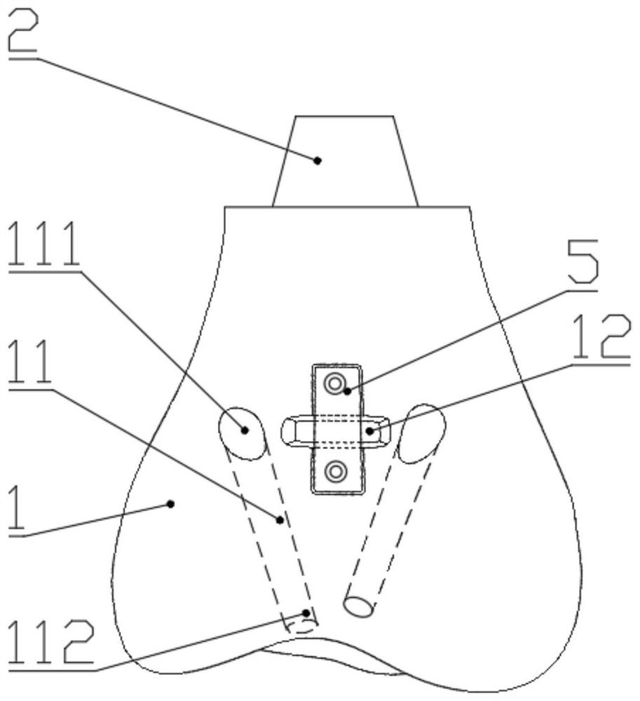 An artificial ligament bionic fixed distal femoral tumor-type half knee joint prosthesis