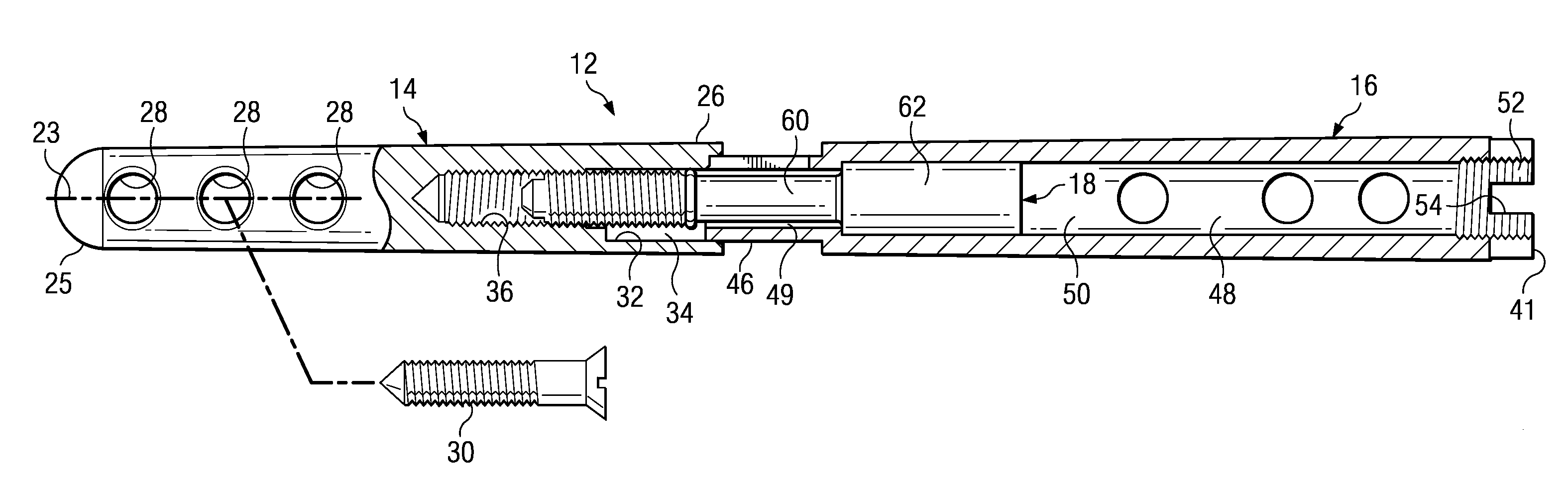 Ankle arthrodesis nail and outrigger assembly