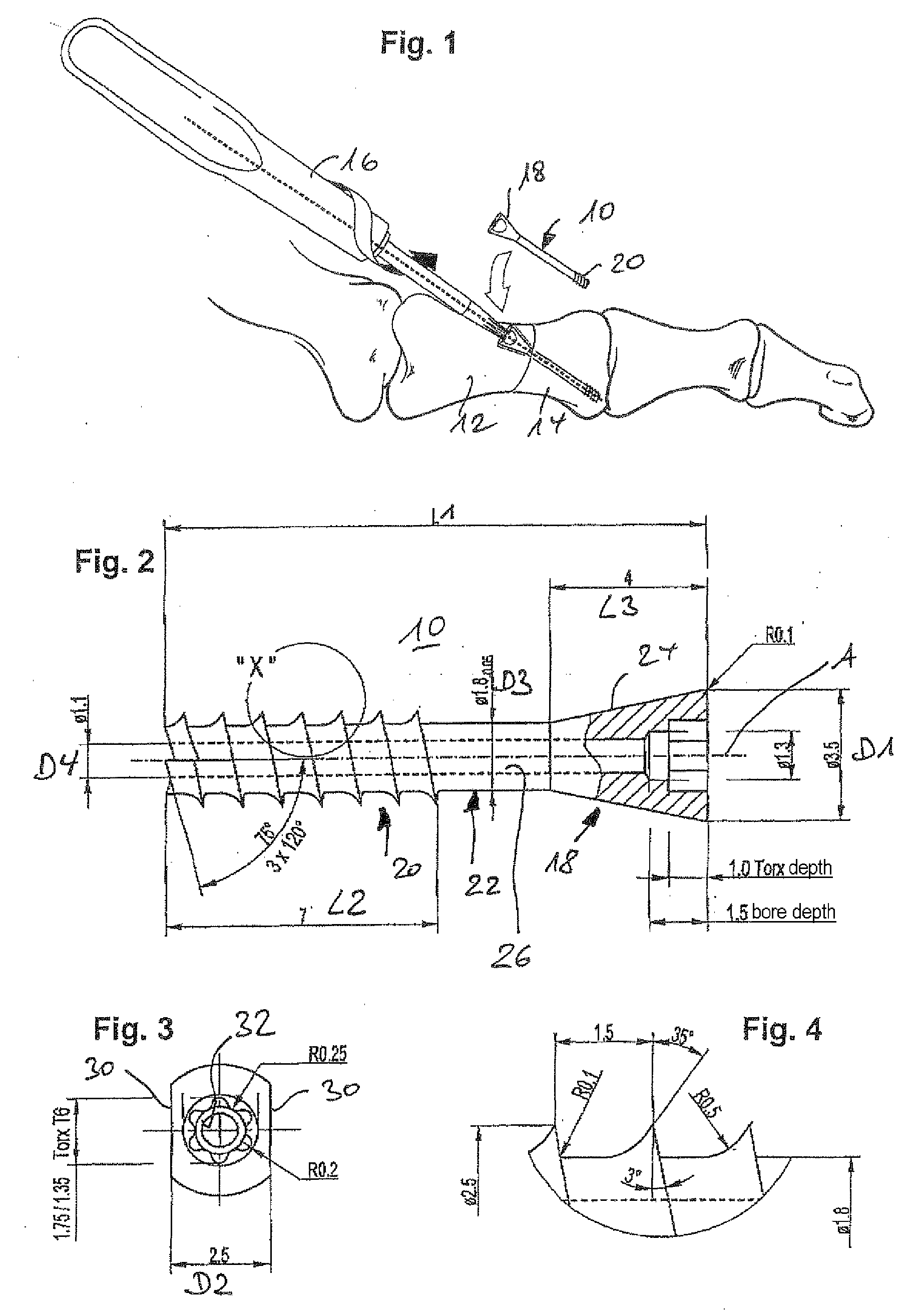 Orthopedic compression screw