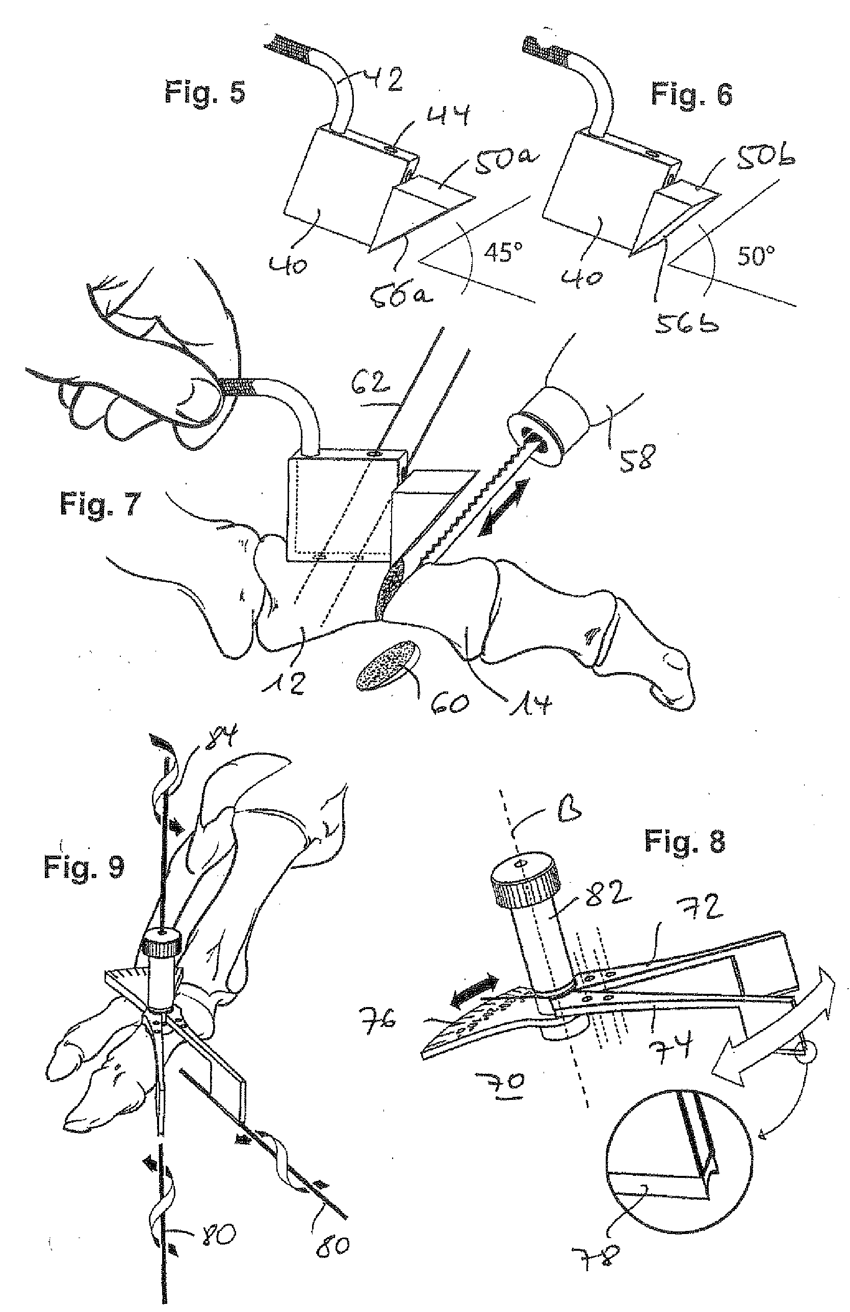 Orthopedic compression screw