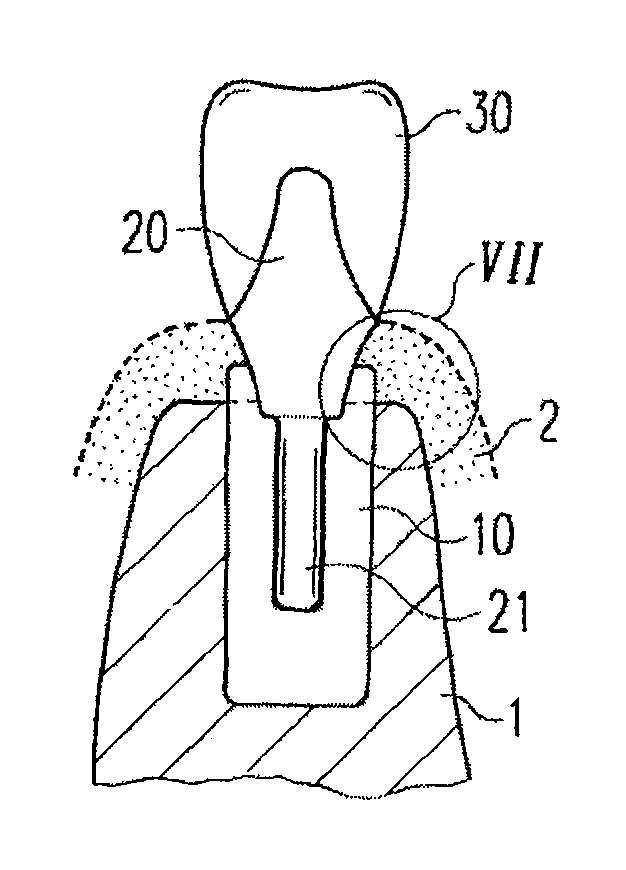 Zirconium oxide-based dental implant and method for producing said dental implant