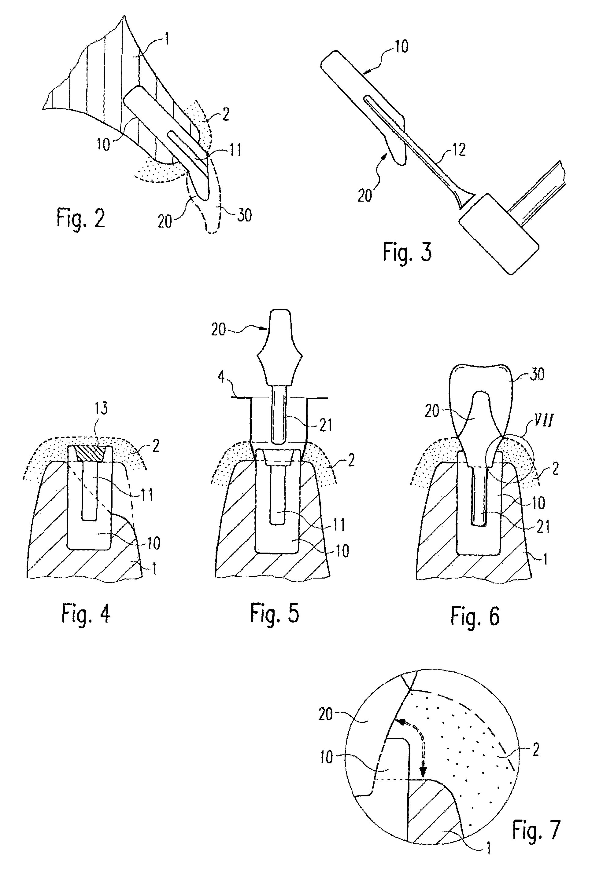 Zirconium oxide-based dental implant and method for producing said dental implant