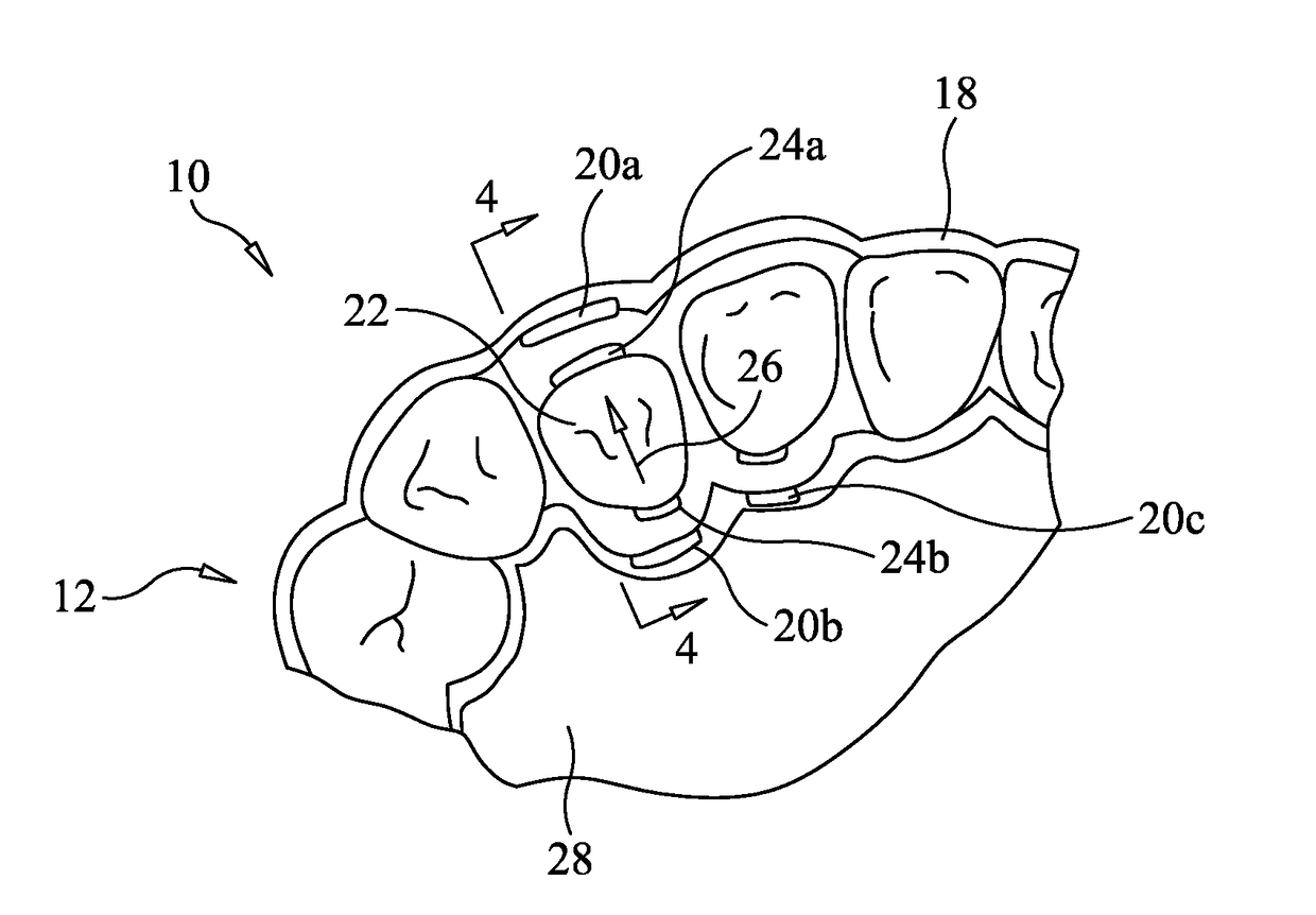 Apparatus and method for correcting orthodontic malocclusions