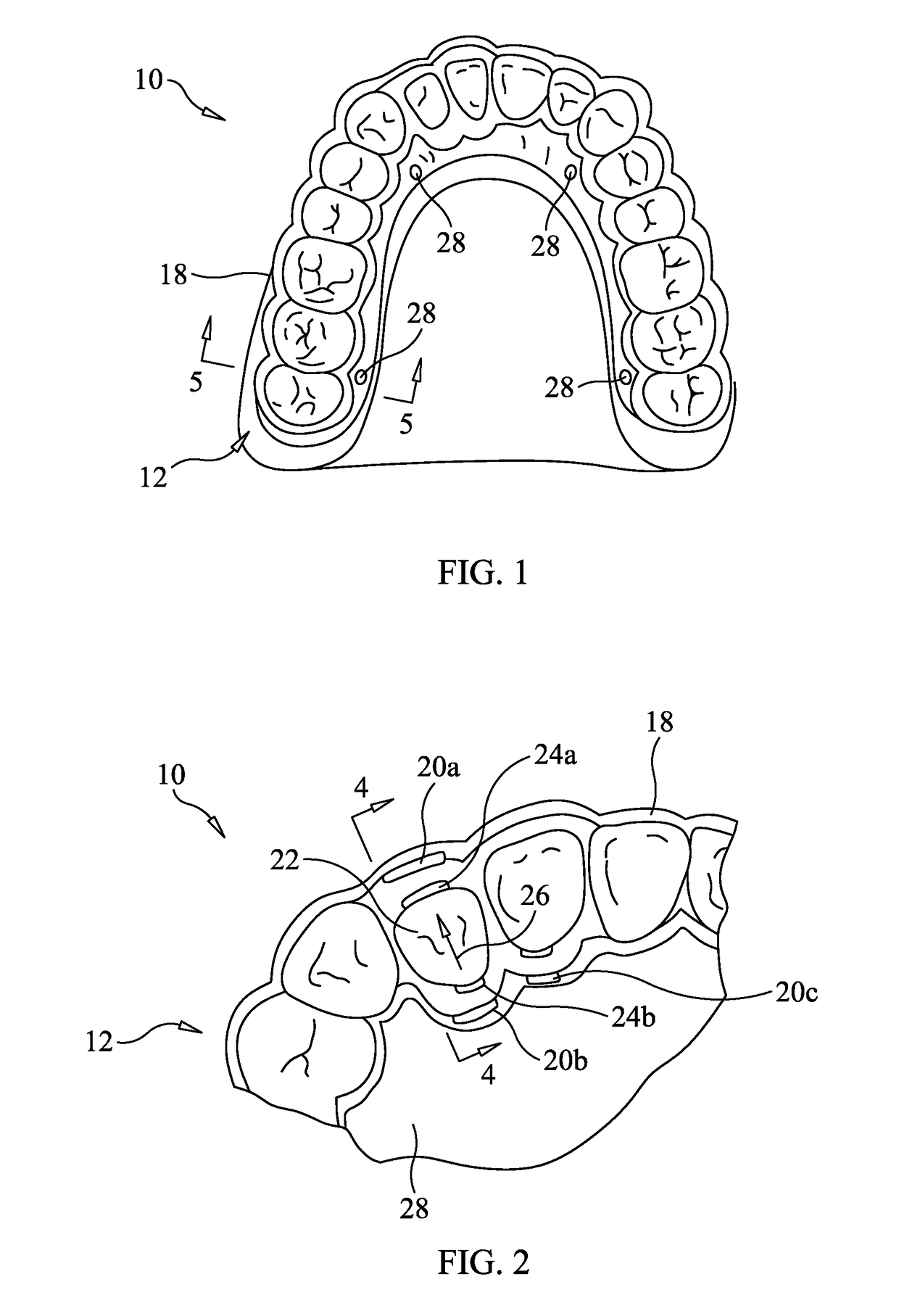 Apparatus and method for correcting orthodontic malocclusions