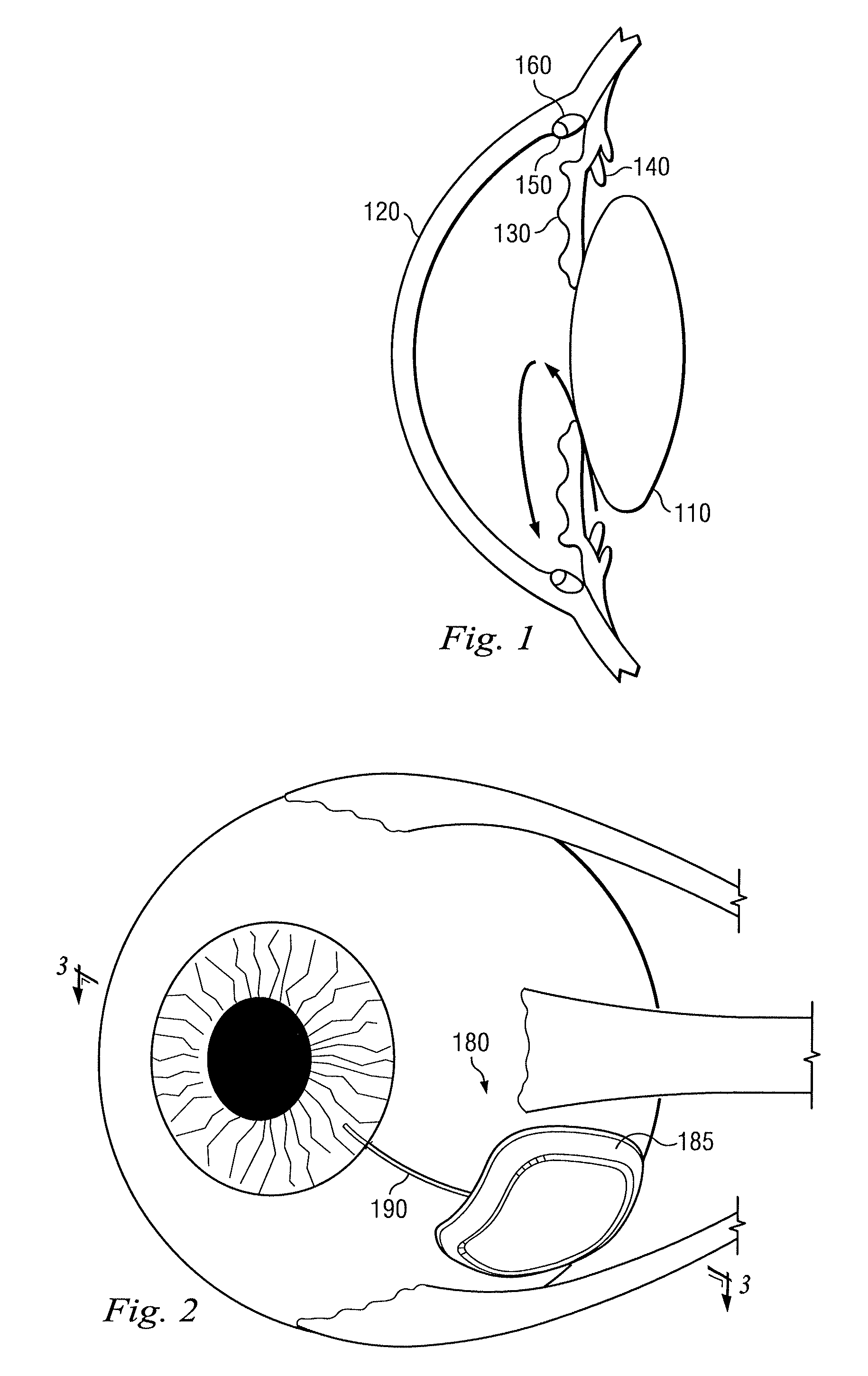 Functionally graded material tube and method for use of the same in implantation