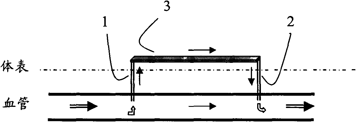 Medical apparatus in parallel with vessels