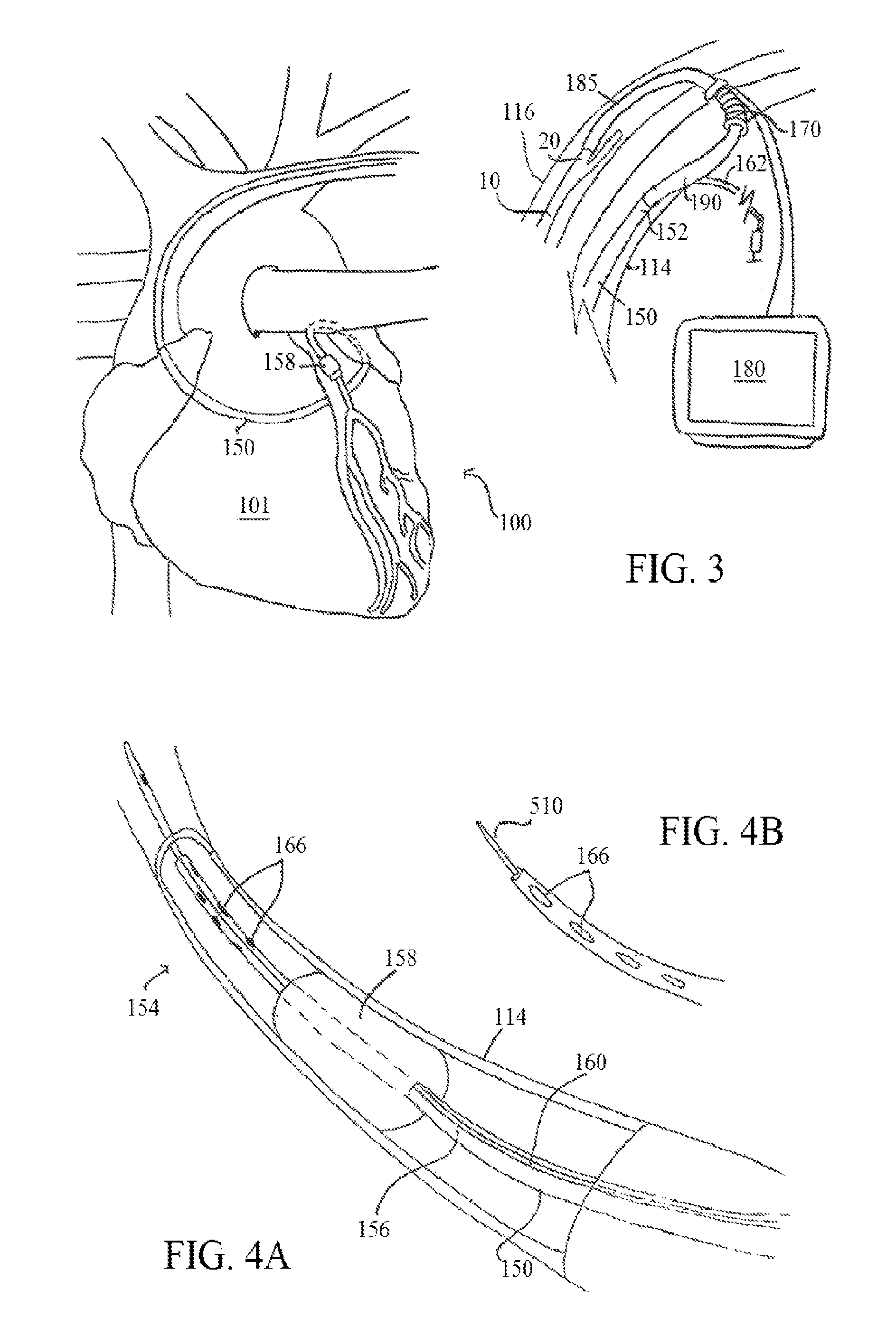 Unitary body systems and devices and methods to use the same for retroperfusion