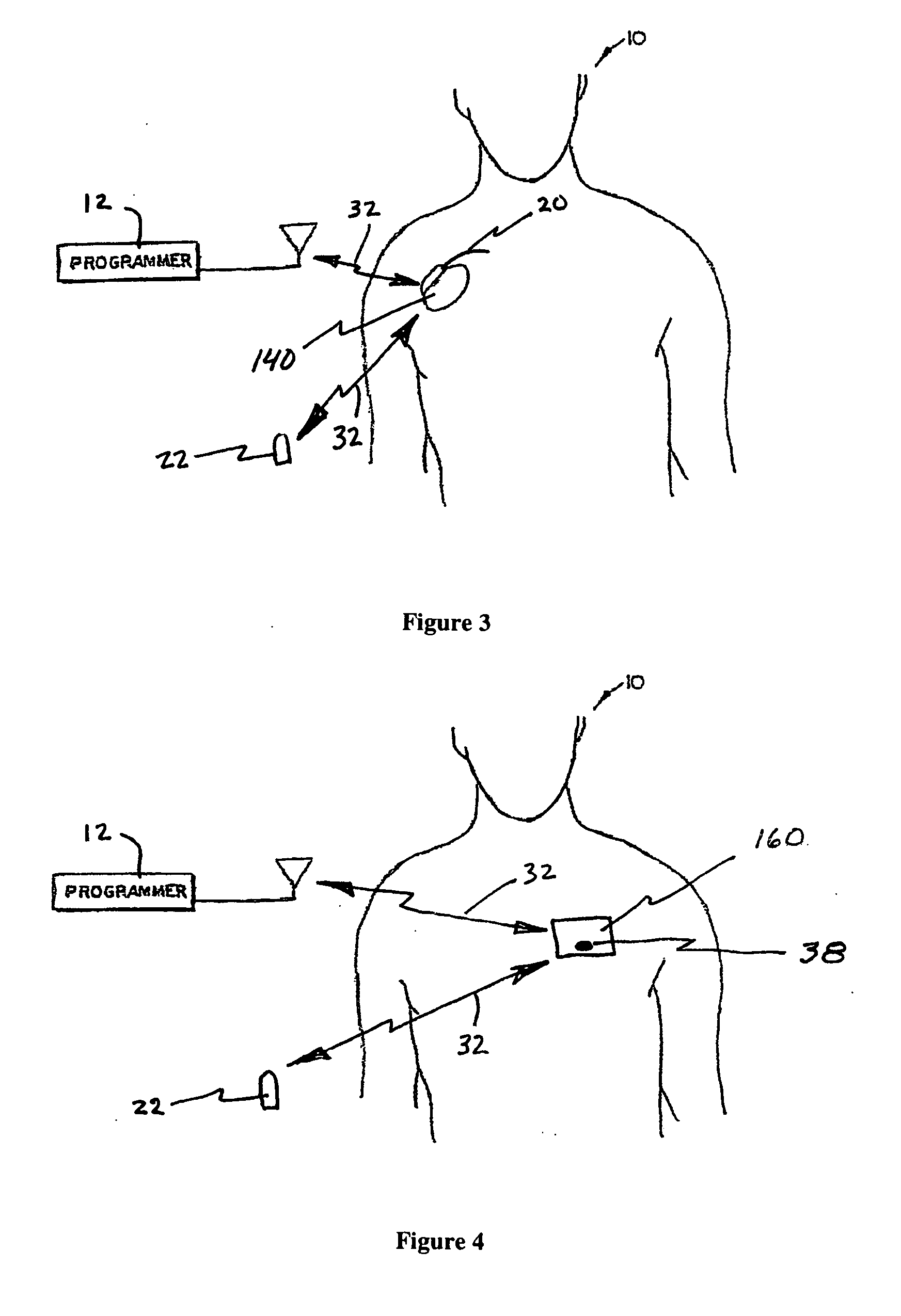 System and method for monitoring or treating nervous system disorders