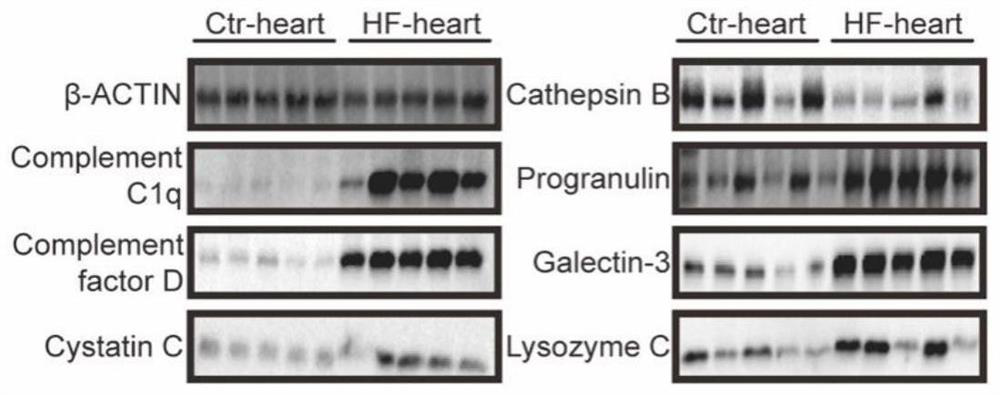 Marker for predicting curative effect of harmful ventricular remodeling and immunotherapy of myocardial infarction patient and application of marker