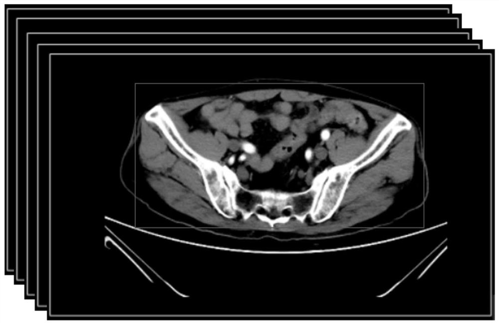 Intelligent diagnosis method for rectal cancer lymph node metastasis