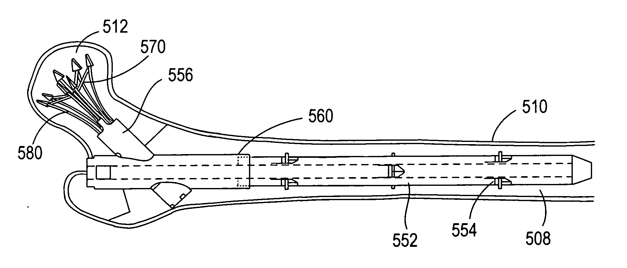 Bone fracture treatment devices and methods of their use