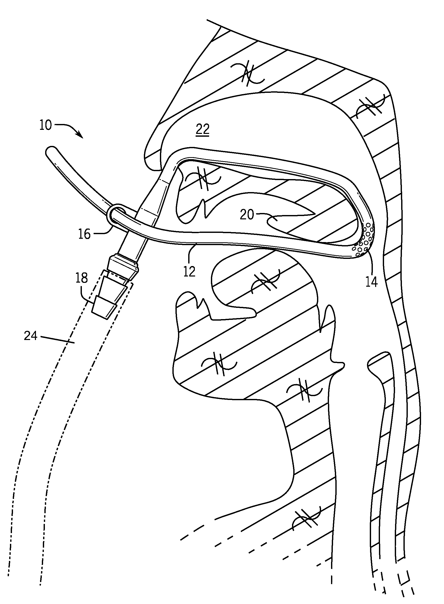 Retractor suction catheter