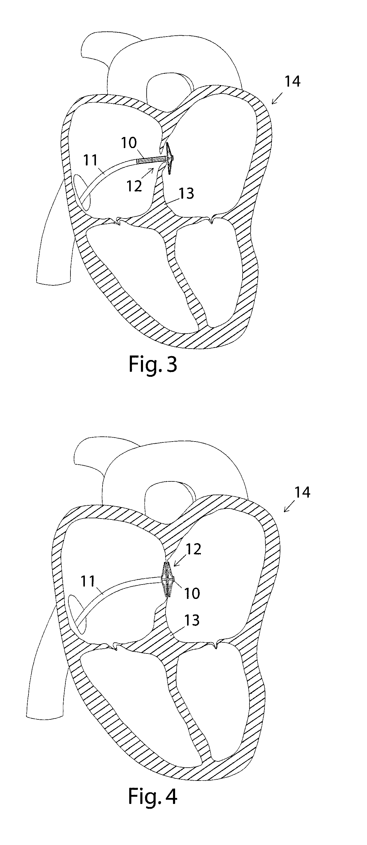 Closure device and insertion assembly